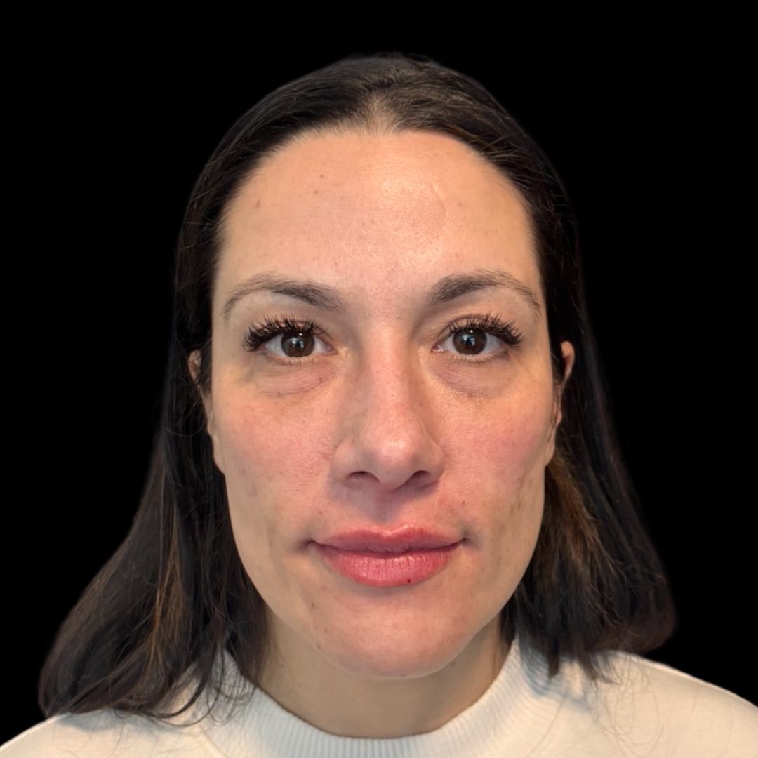 Before dermal filler in the lips at House of Aesthetics in Cary, NC (14).png
