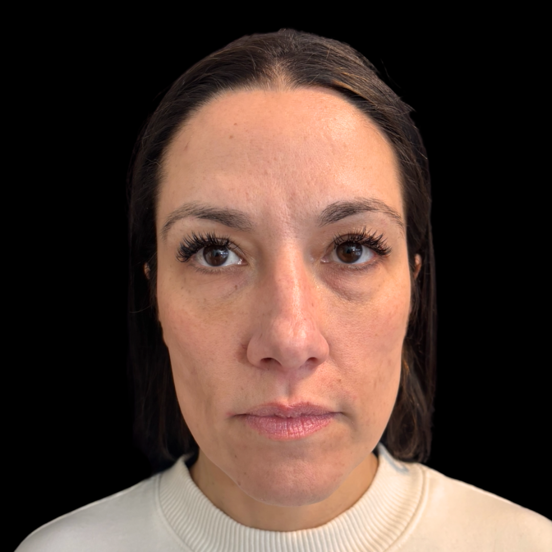 Before dermal filler in the lips at House of Aesthetics in Cary, NC (13).png