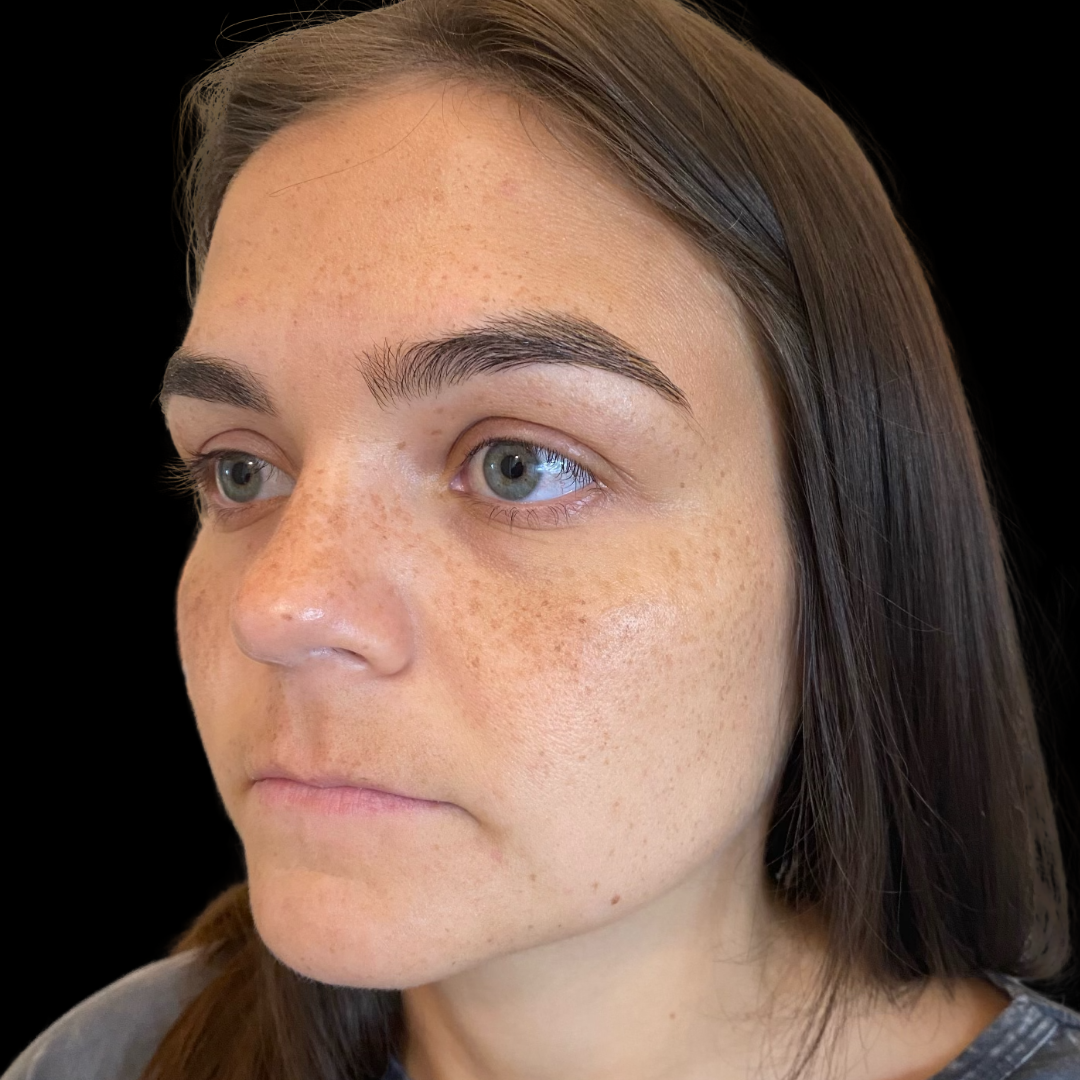 Before dermal filler in the lips at House of Aesthetics in Cary, NC (13).png