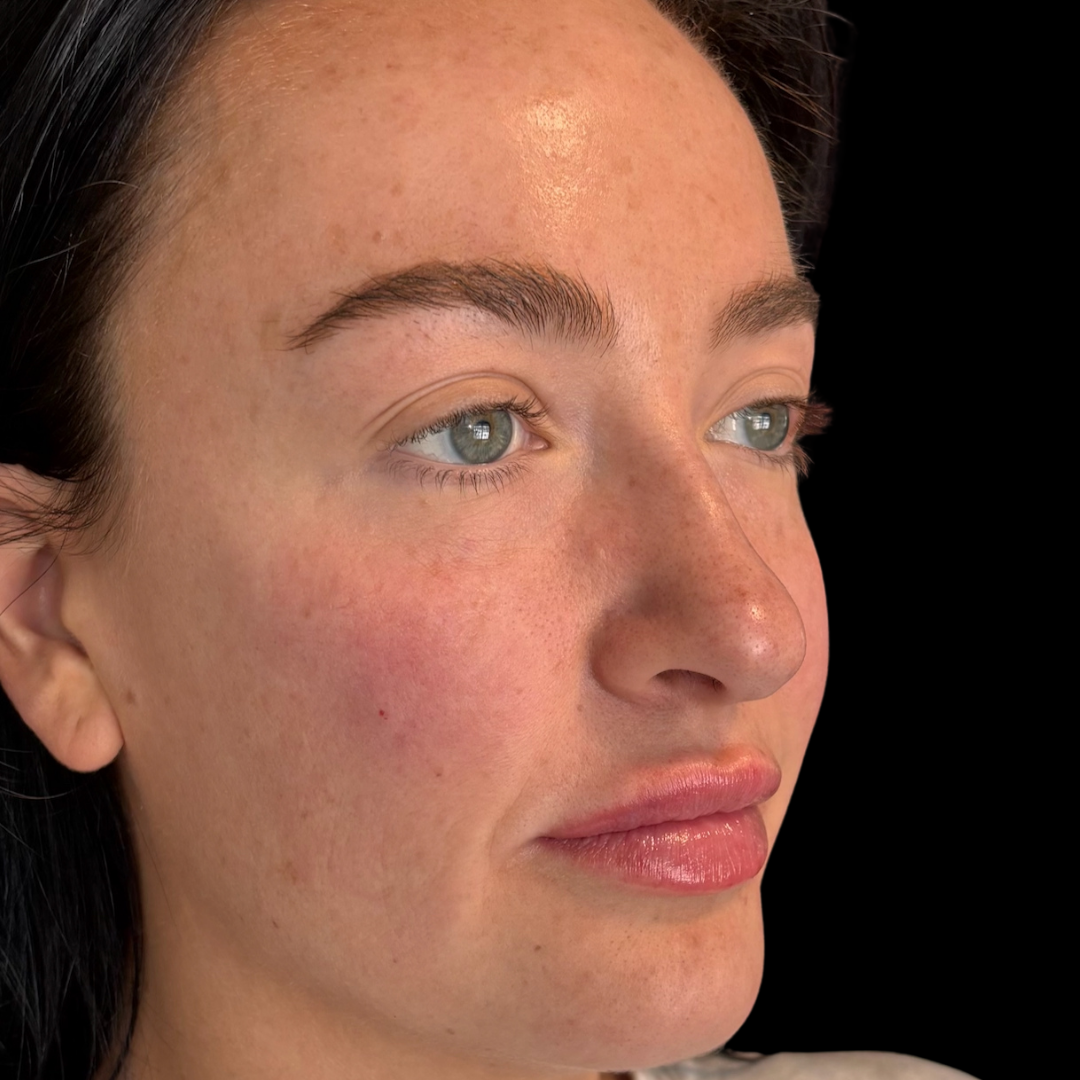 After dermal filler in the lips at House of Aesthetics in Cary, NC.png