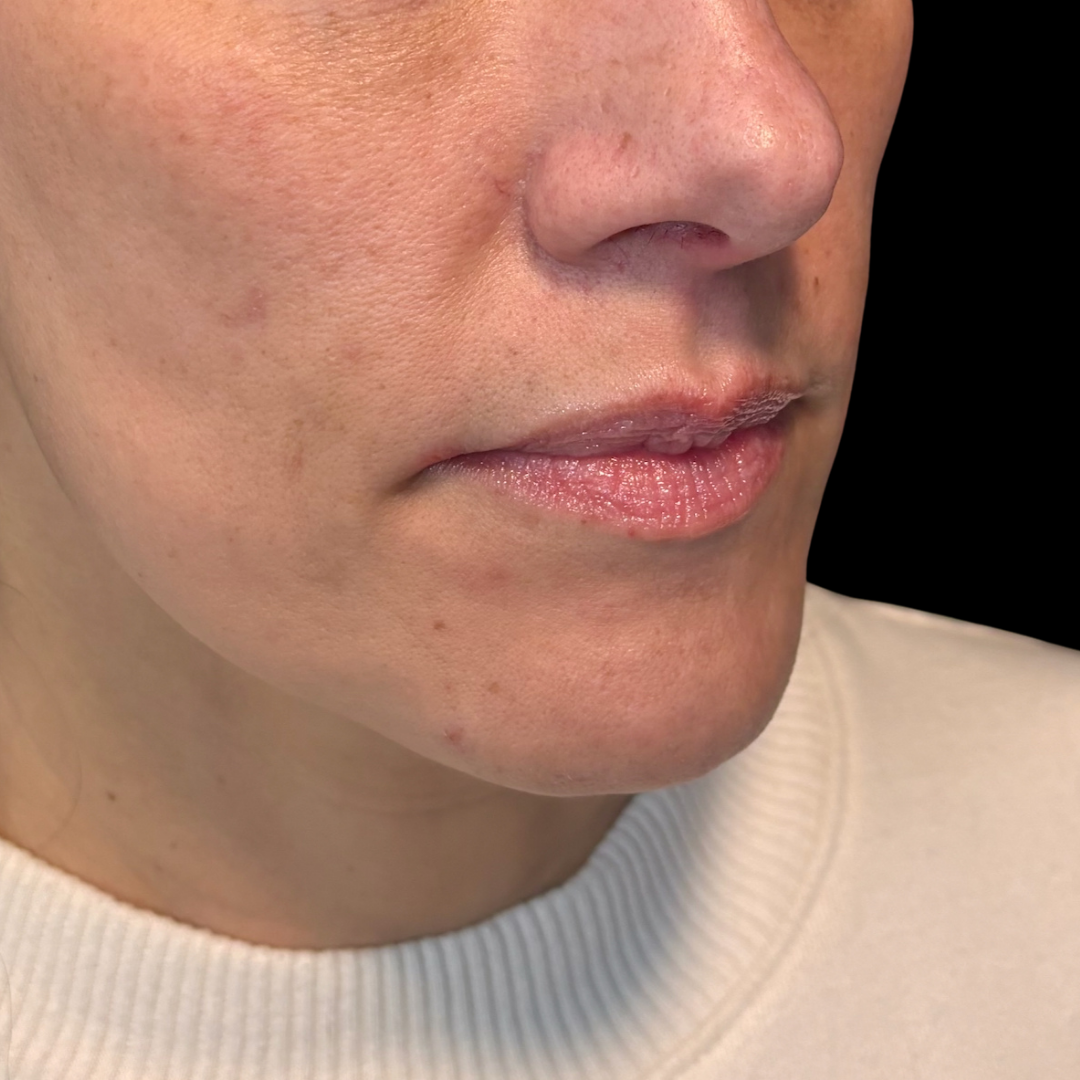Before dermal filler in the lips at House of Aesthetics in Cary, NC (23).png