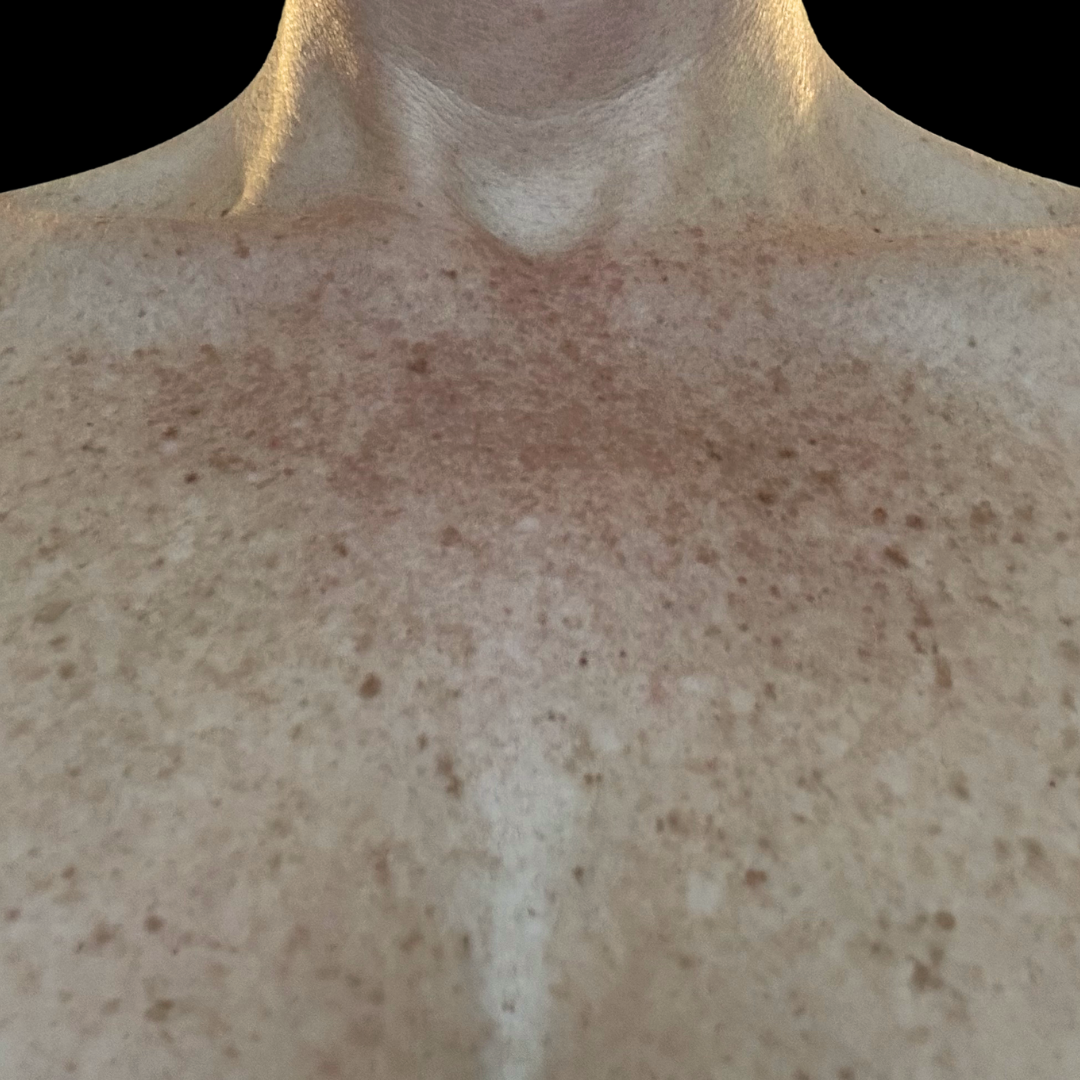 Before dermal filler in the lips at House of Aesthetics in Cary, NC copy 2.png