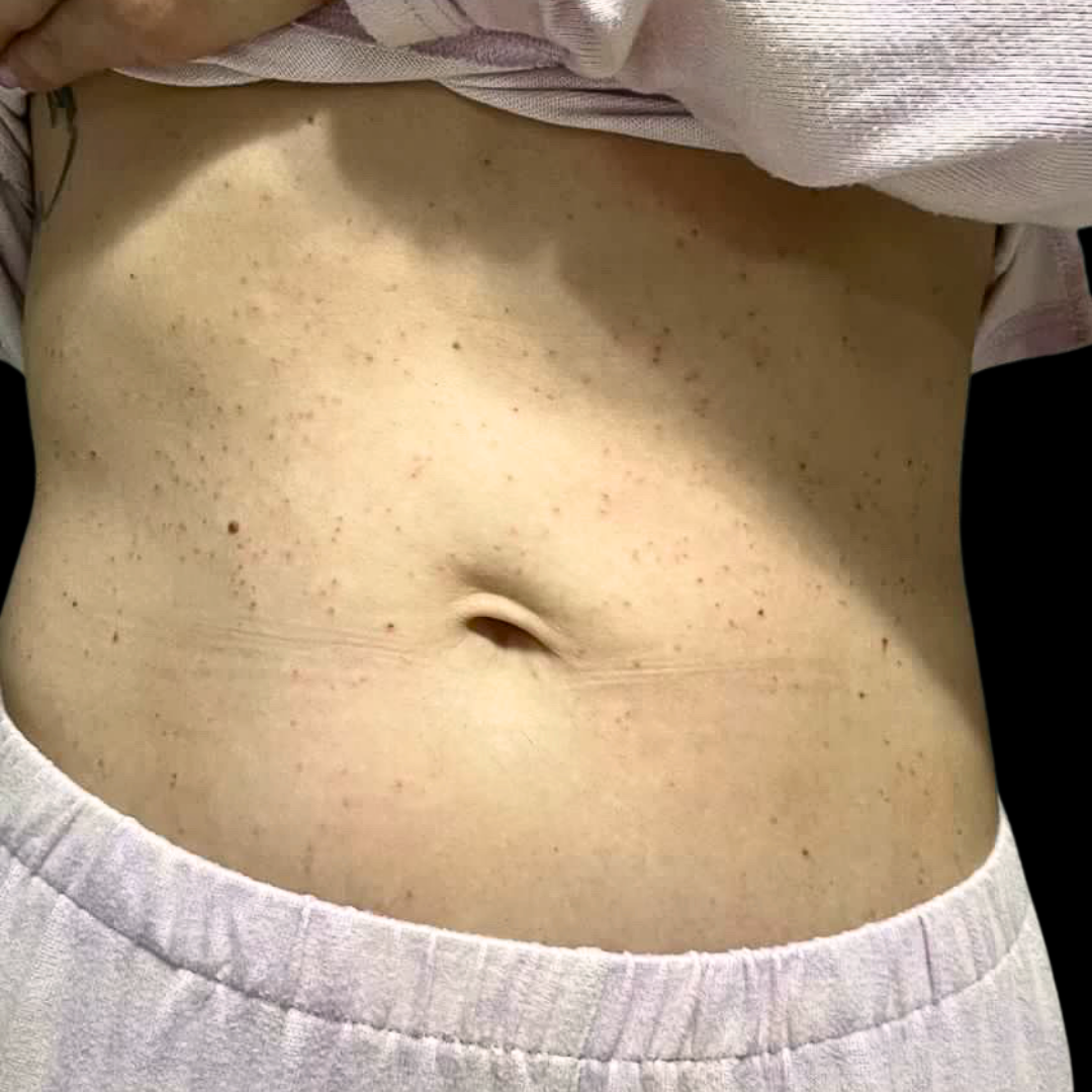 Before Laser to Improve Brown Spots at House of Aesthetics.png