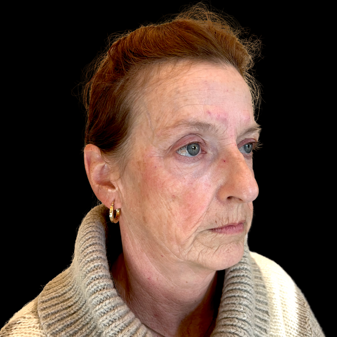 Before dermal filler in the lips at House of Aesthetics in Cary, NC (3).png