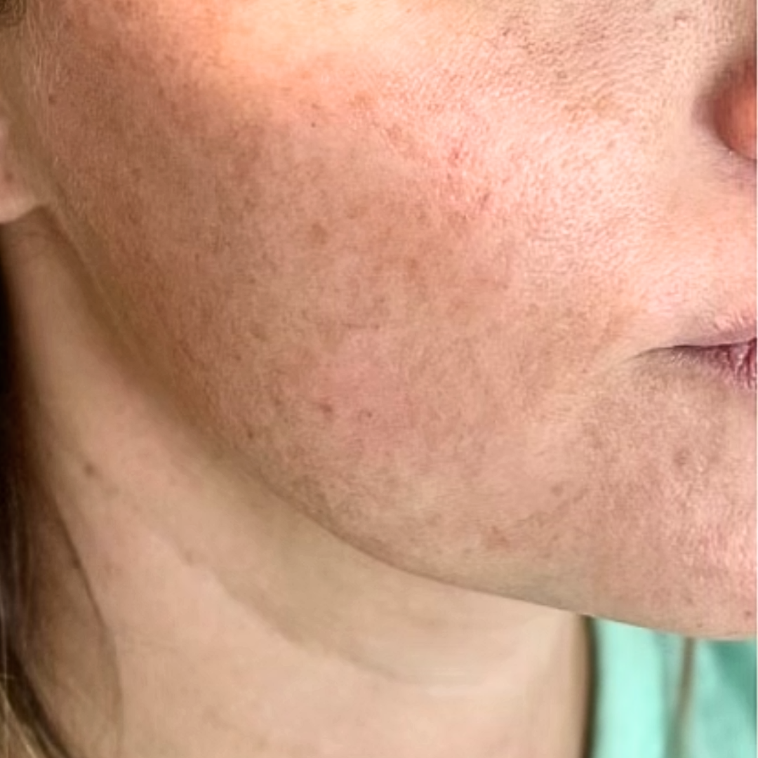 Before Broadband Light Laser at House of Aesthetics in Cary.png