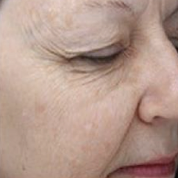 After Hybrid Fractional Laser 5.png