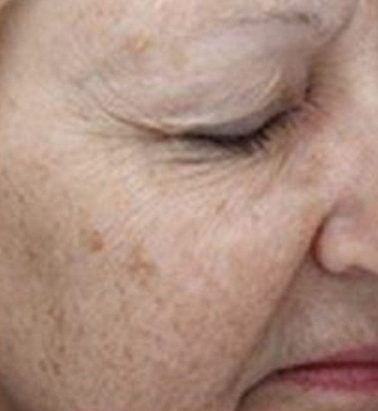 Before Hybrid Fractional Laser 5.png