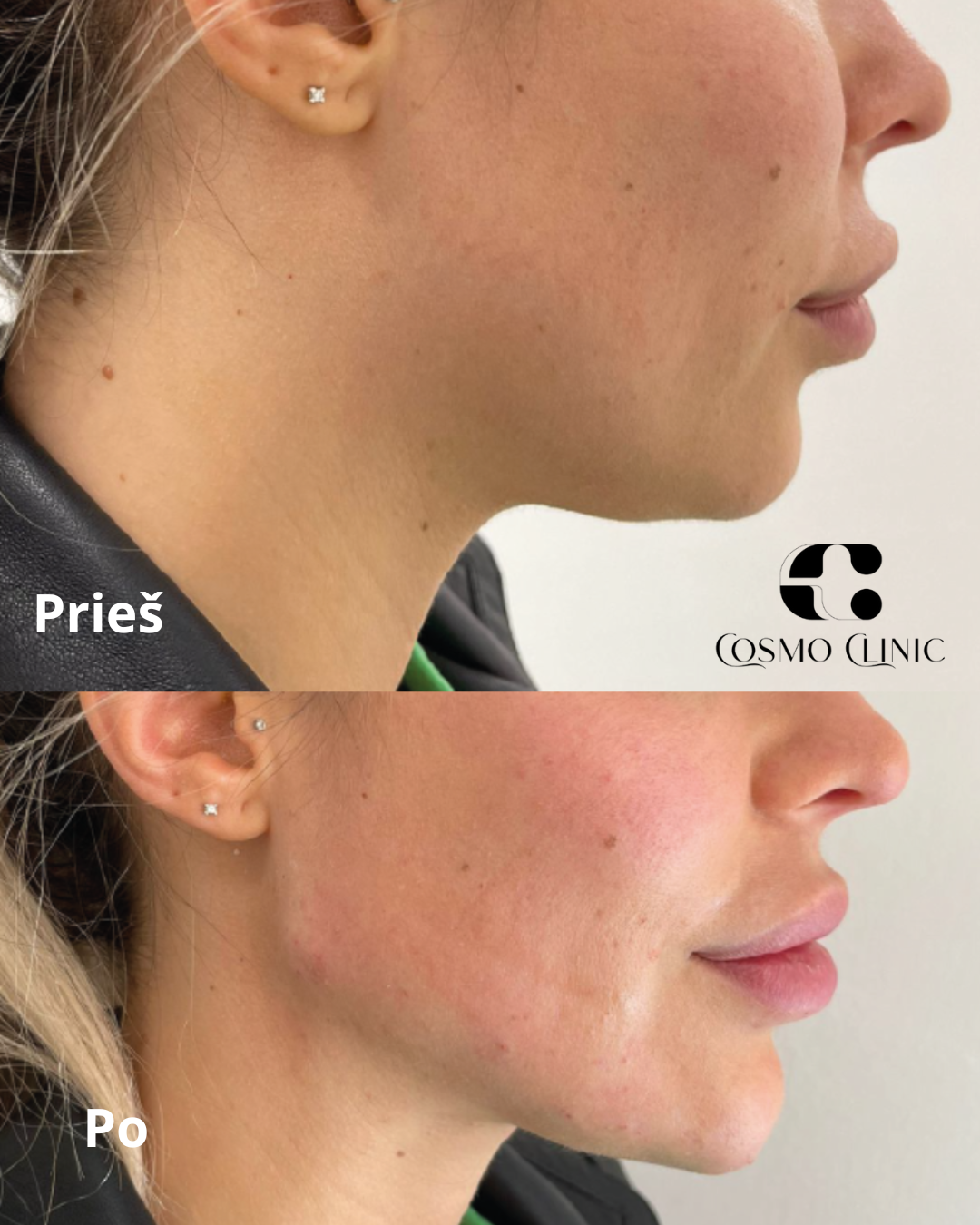 Comparison photo of a woman's face showing skin improvements. The top image labeled 'Prieš' depicts her skin before treatment, with uneven tone and blemishes. The bottom image labeled 'Po' shows her skin after treatment, with a smoother, clearer comp