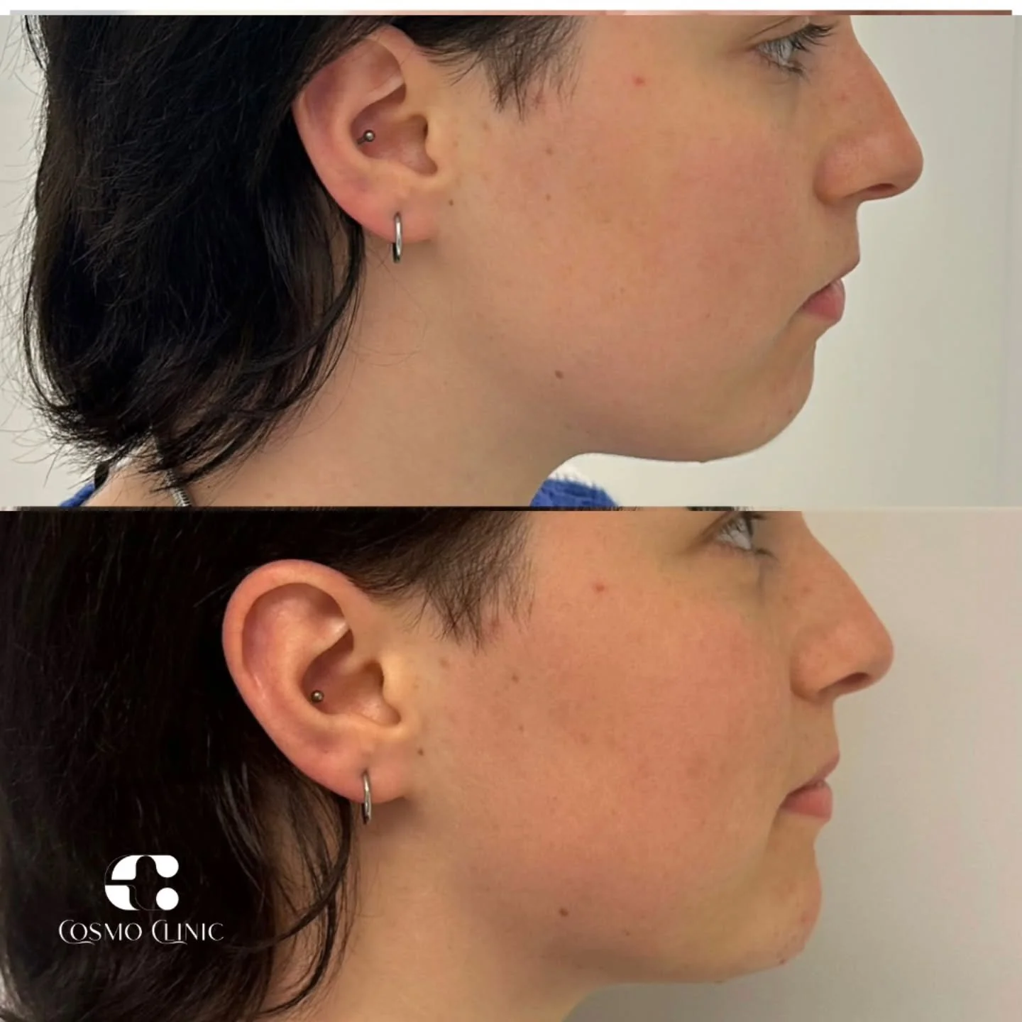 Smakro formavimas hialurono rūg&scaron;timi &ndash; greitas ir minimaliai invazyvus būdas suteikti veidui daugiau harmonijos. Procedūros metu hialurono rūg&scaron;tis subtiliai modeliuoja smakro liniją, i&scaron;ry&scaron;kina profilį ir suteikia vei