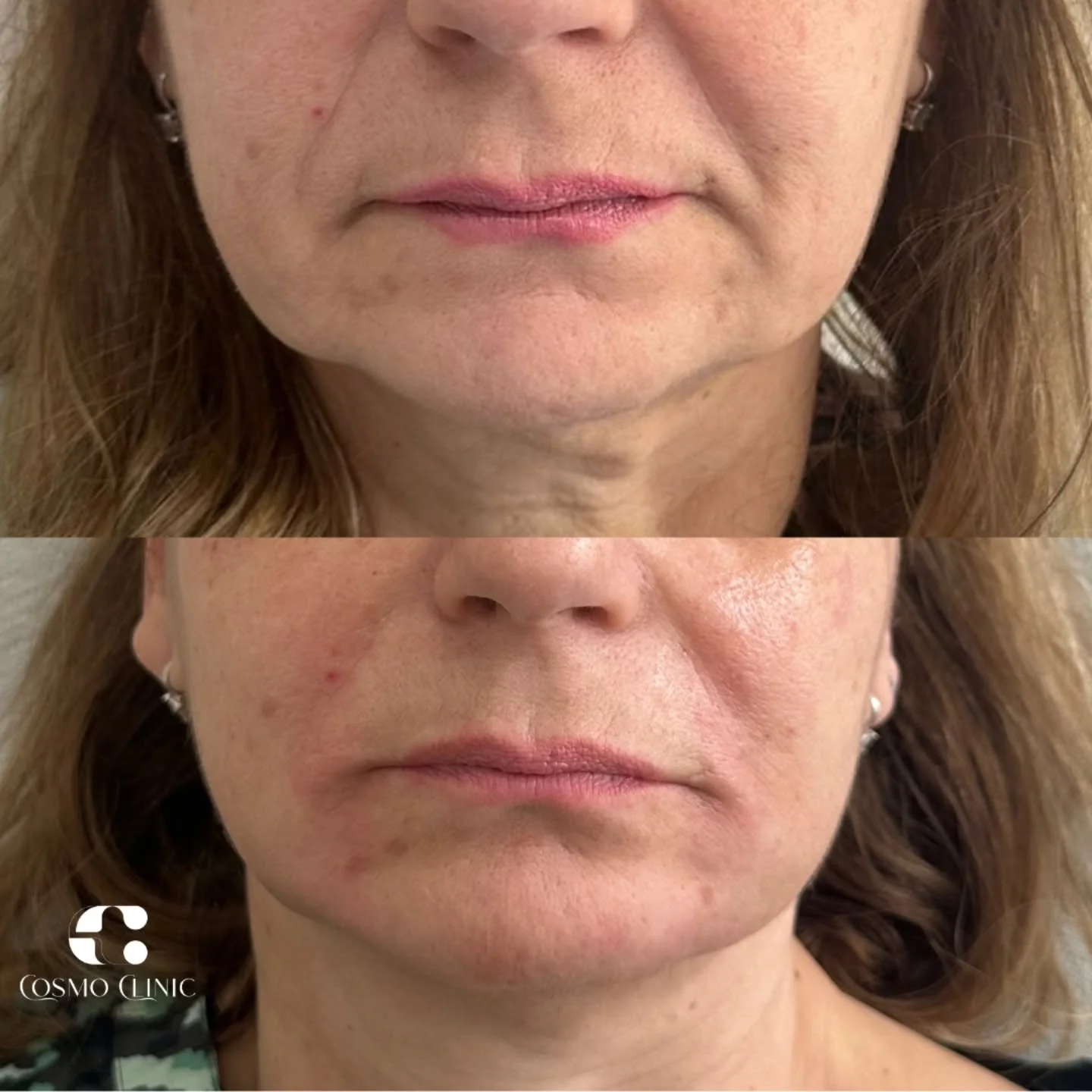 Grąžiname tai, ką laikas atėmė! 

Vos keli gydytojo prisilietimai ir dingsta nasolabialinės, marionetės rauk&scaron;lės, &quot;buldogo žandai&quot;! 

Užtenka vienos procedūros! 

#veidas #rauk&scaron;les #atjauninimas #jaunystė #procedūra #vilnius