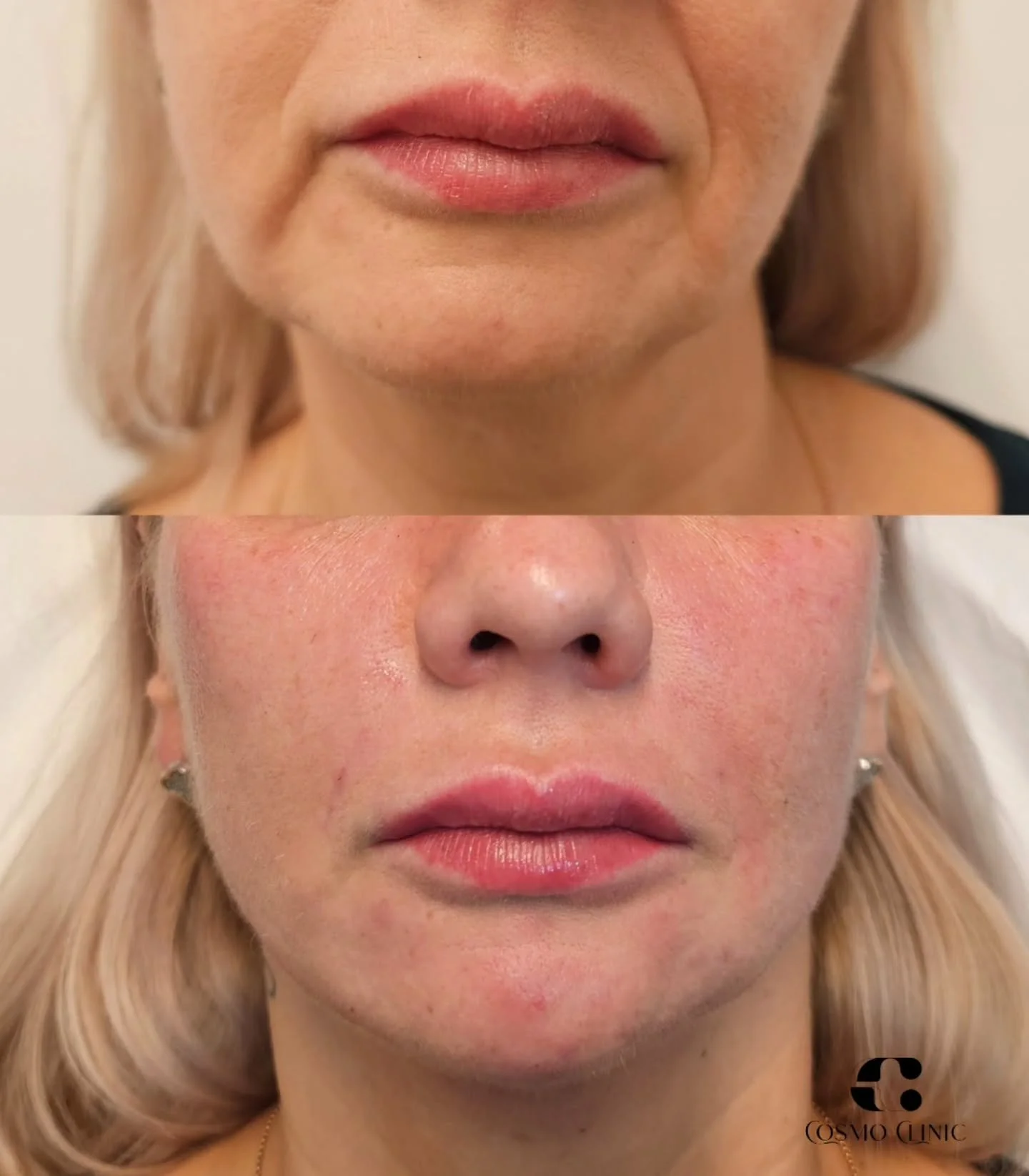 Natūralus efektas, greiti rezultatai , viena procedūra - didelis pokytis. ✨

Procedūra subtiliai sumink&scaron;tina gilesnes linijas, i&scaron;ry&scaron;kina veido kontūrus ir suteikia &scaron;velnesnį, poilsėjusį įvaizdį! 

Para&scaron;yk mums žinut