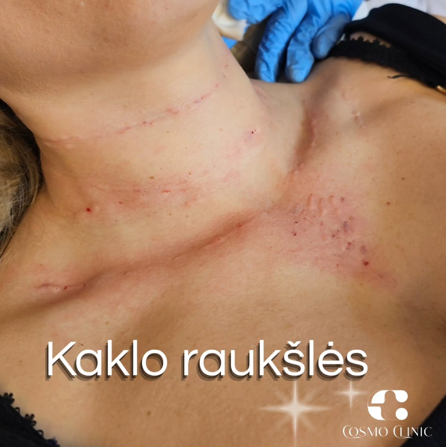 3 žingsnių planas!

1️⃣ Biorevitalizacija
Pirmas žingsnis &ndash; intensyvus odos drėkinimas i&scaron; vidaus. Biorevitalizacija atstato odos elastingumą, pagerina tonusą ir paruo&scaron;ia kaklą tolimesnėms procedūroms.

2️⃣ Rauk&scaron;lės užpildym