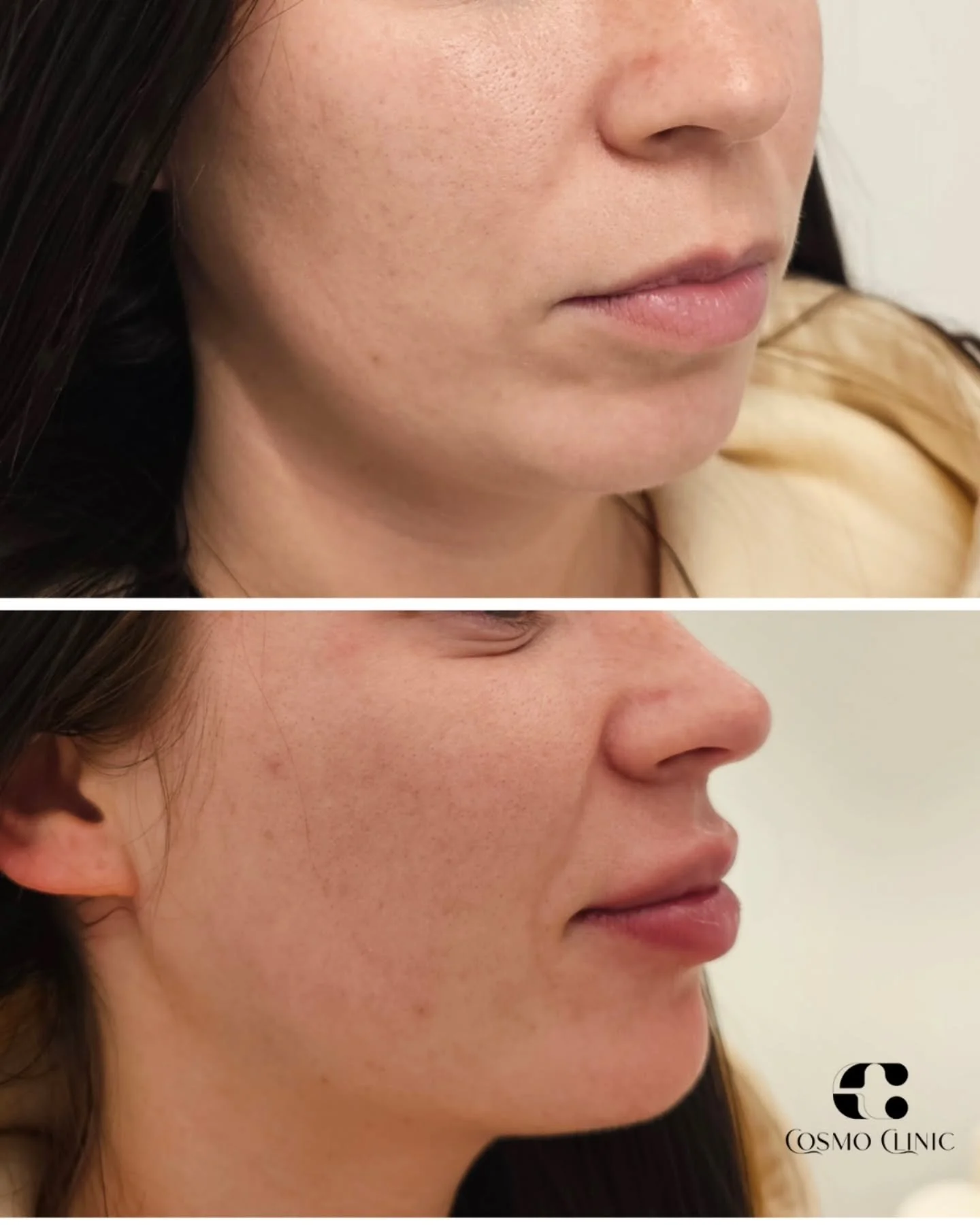 SMAKRAS‼️ veido harmonijai turi labai didelę įtaką! 

"Net nežinojau, kad man to smakro trūksta. Bet dabar matau, kaip pasikeitė veidas! Wow! " - su tokiais žodžiais palydėjome &scaron;iandien savo pacientę❤️🌸 

Užsira&scaron;yti į konsult