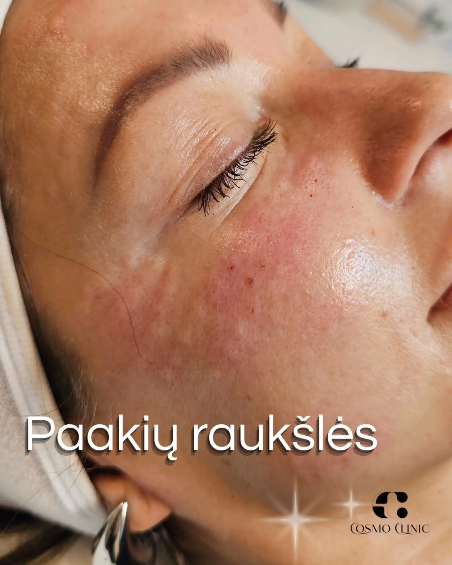 1. Įvertink rauk&scaron;lių tipą
&ndash; Ar tai mimikos rauk&scaron;lės (&bdquo;žąsų kojelės&ldquo;)?
&ndash; Ar oda plona, sausa, praradusi stangrumą?

2. Pasikonsultuok su specialistu
&ndash; Konsultacijos metu nustatoma, kuri procedūra tinkamiausi