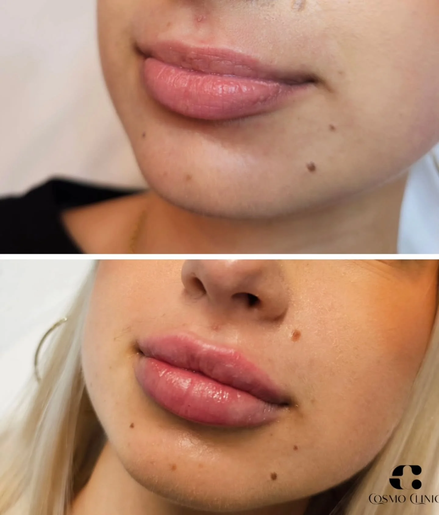WOW efektas vos per kelias minutes. 💋✨
Jei nori pokyčio &ndash; tiesiog para&scaron;yk mums ir rezervuok laiką.
 Tau tereikia padaryti žingsnį!

#lupos #lips #hialuronas #veidas #lipcare #VilniusBeauty