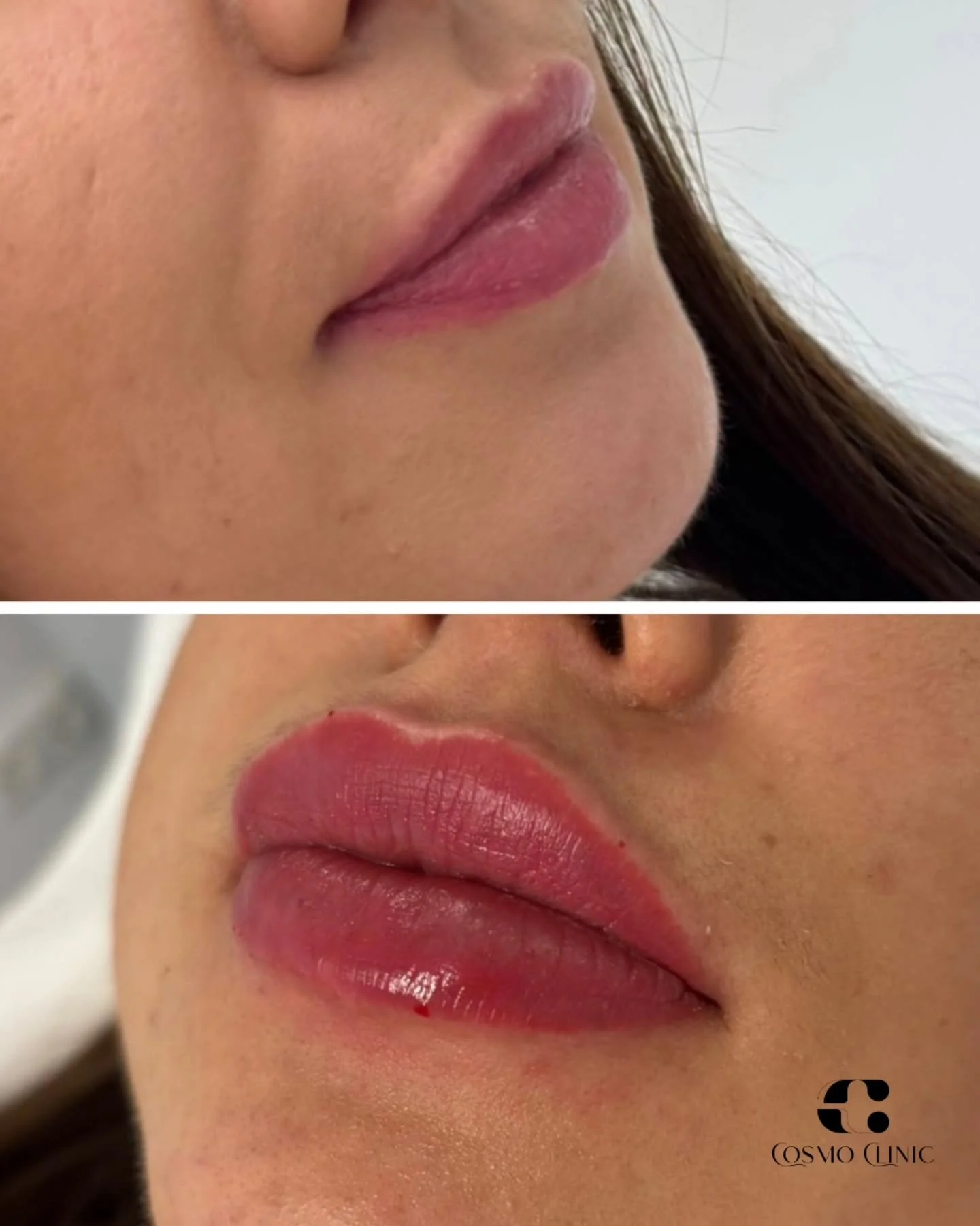 Svajoji apie &scaron;velniai putlesnes, dailiai i&scaron;ry&scaron;kintas lūpas? Lūpų putlinimas suteikia gaivų, natūralų efektą vos per kelias minutes. 💋✨
Jei nori pokyčio &ndash; tiesiog para&scaron;yk man ir rezervuok laiką. Tau tereikia žingsnio