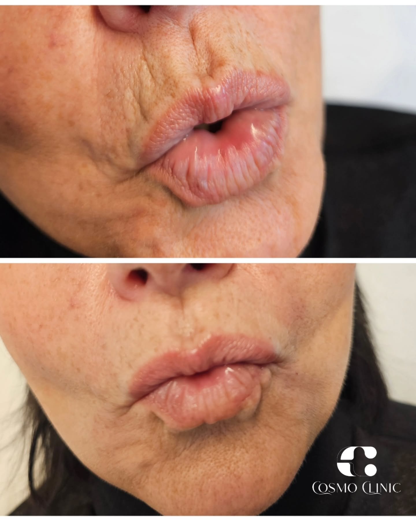 &bdquo;barcode&ldquo; rauk&scaron;lės aplink lūpas &ndash; dažna problema, atsirandanti dėl mimikos, amžiaus ar odos sausumo.

 Rauk&scaron;lių pildymas hialurono rūg&scaron;timi padeda subtiliai i&scaron;lyginti odą, atkurti drėgmę ir suteikti jauna