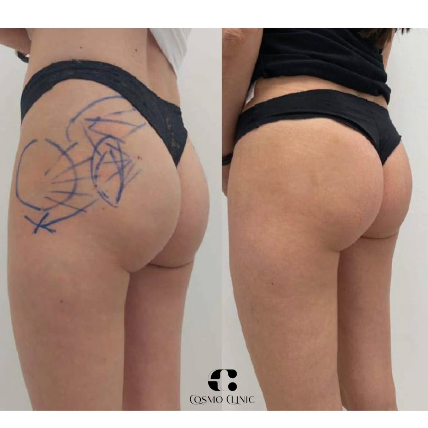 O jeigu be treniruočių...😉 

Sėdmenų formavimas hialuronu 🍑
Tai nechirurginė procedūra, skirta subtiliai pagerinti sėdmenų formą, suteikti apimties ir stangrumo. Hialurono rūg&scaron;tis padeda i&scaron;lyginti nelygumus ir pary&scaron;kinti kontūr