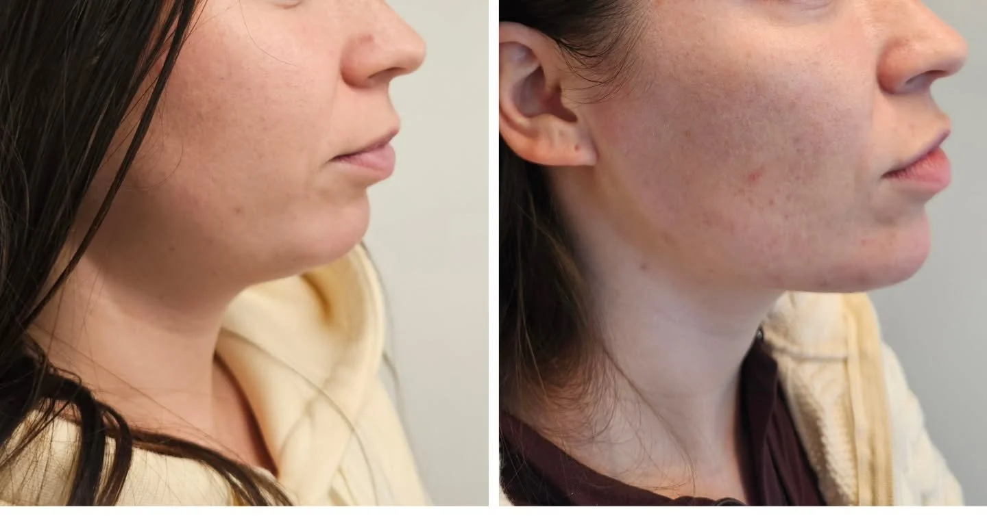 Subtilus, bet labai efektyvus būdas pary&scaron;kinti veido kontūrus. 💉
Procedūra padeda atkurti proporcijas, suteikia veidui daugiau struktūros ir vizualiai &bdquo;sutvarko&ldquo; apatinę veido dalį.

Para&scaron;yk mums - sužinok daugiau