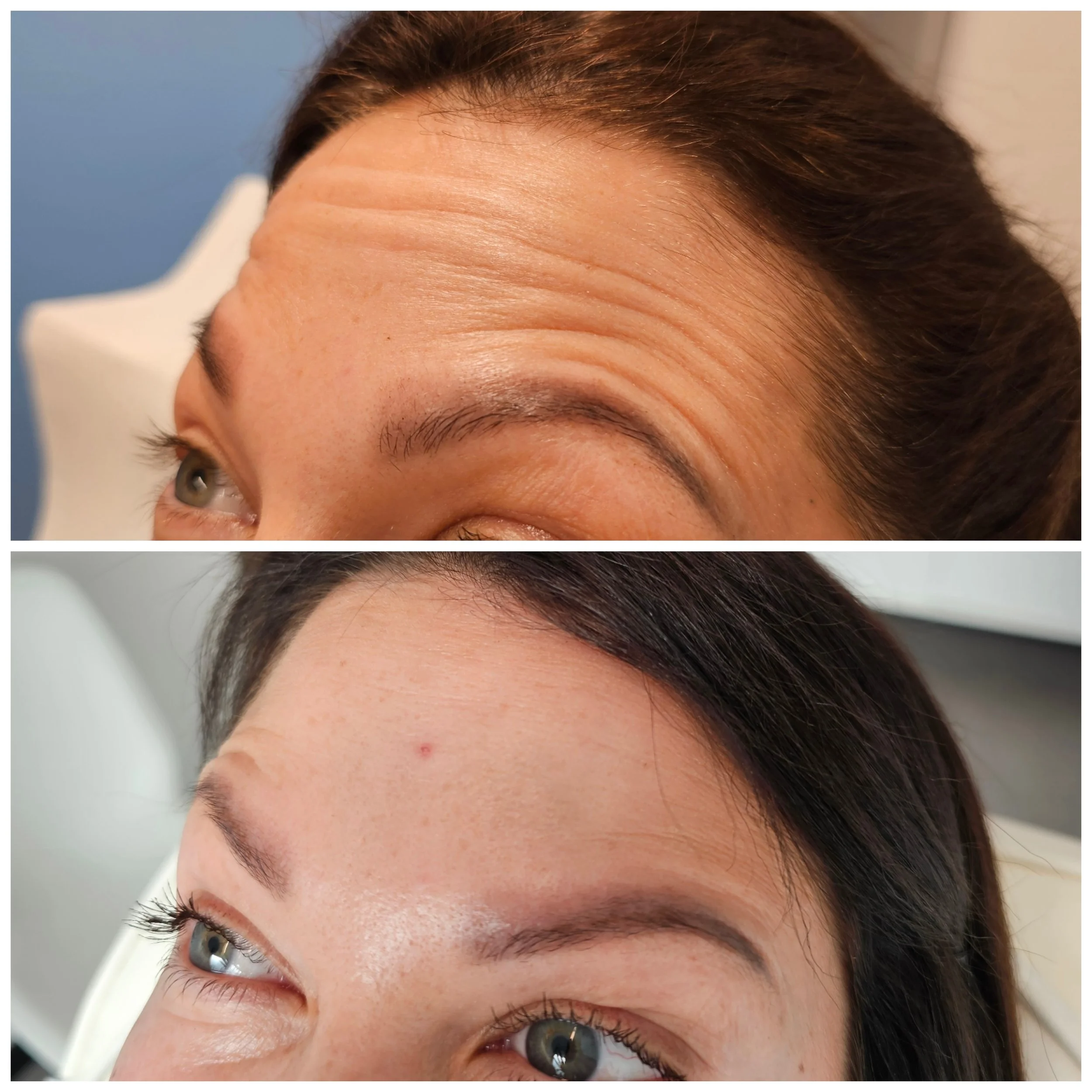 Before and after images of a woman's forehead showing reduction of wrinkles.