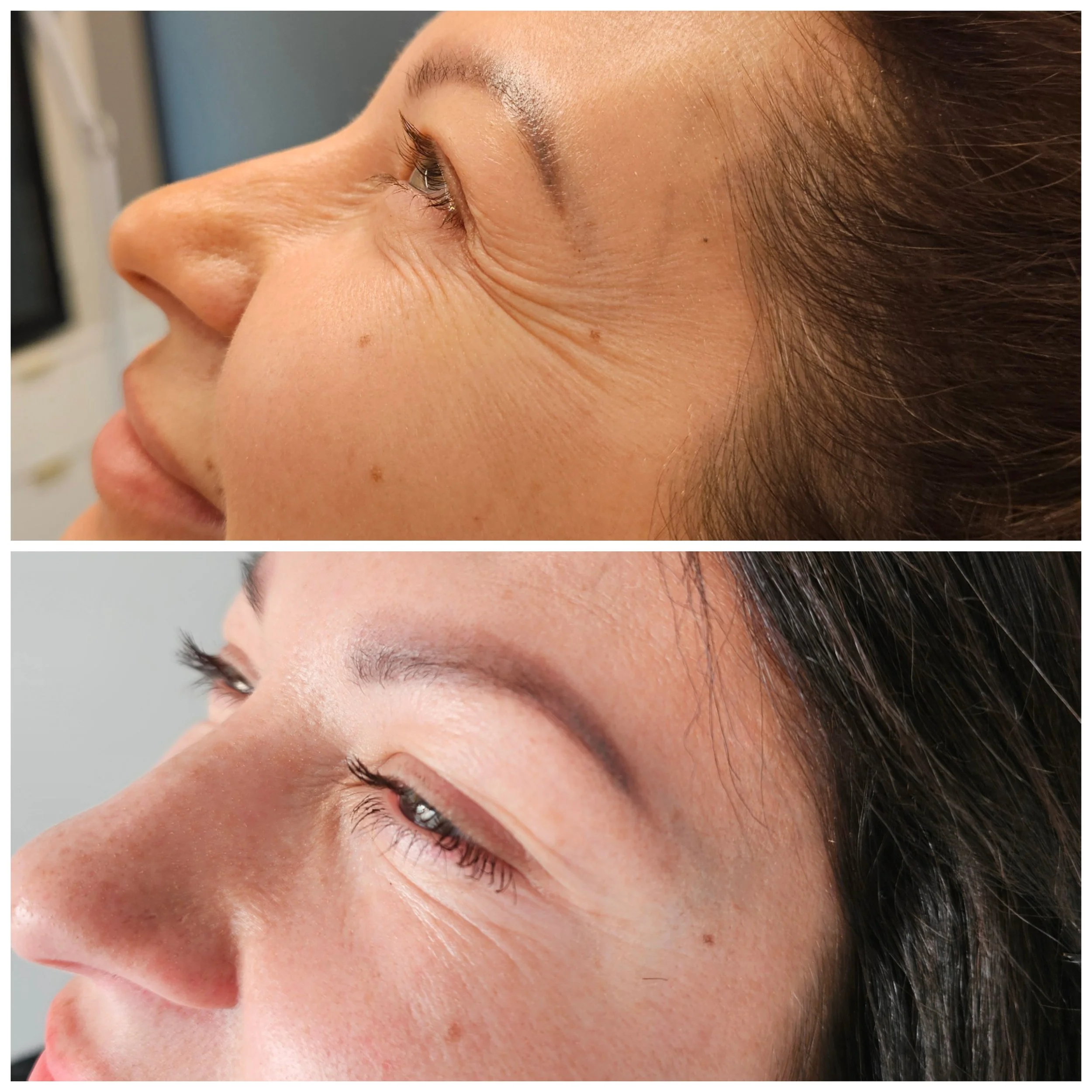 Side-by-side comparison of a woman's face showing the reduction of wrinkles around the eye area, before and after cosmetic treatment or skincare.