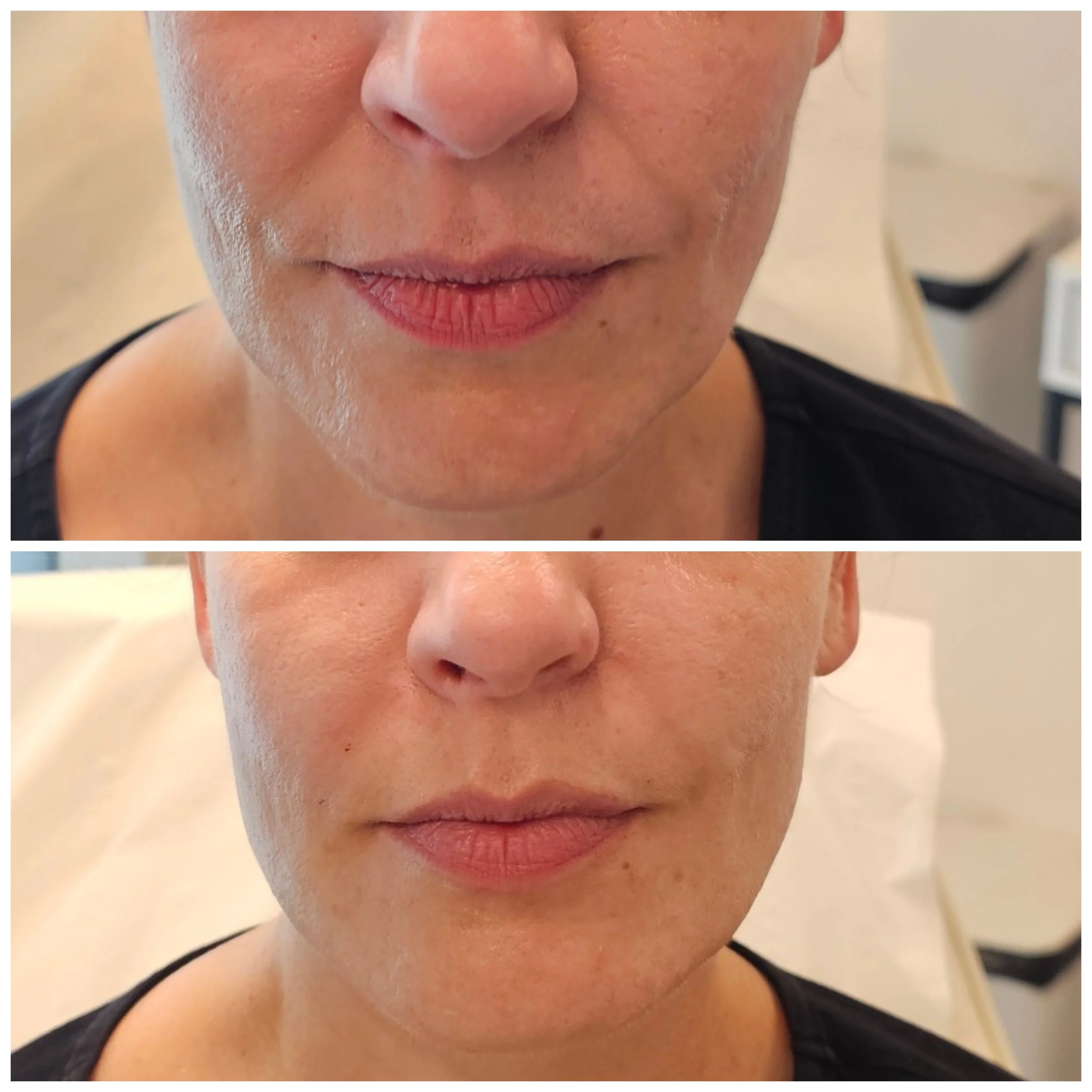 Close-up of a woman's lips and lower face, before and after cosmetic lip enhancement, showing fuller lips in the second image.