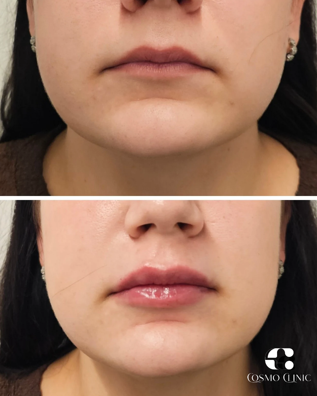 Before and after images of a woman's lips, showing a lip augmentation procedure, with the after photo featuring fuller, glossy lips.