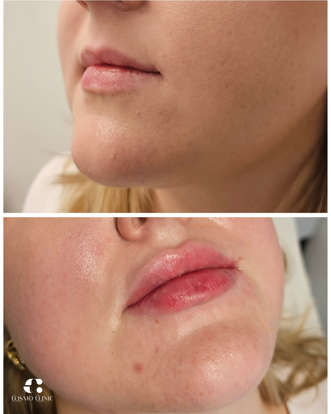Close-up comparison of a woman's face before and after a skincare treatment, showing reduced skin imperfections and improved complexion.