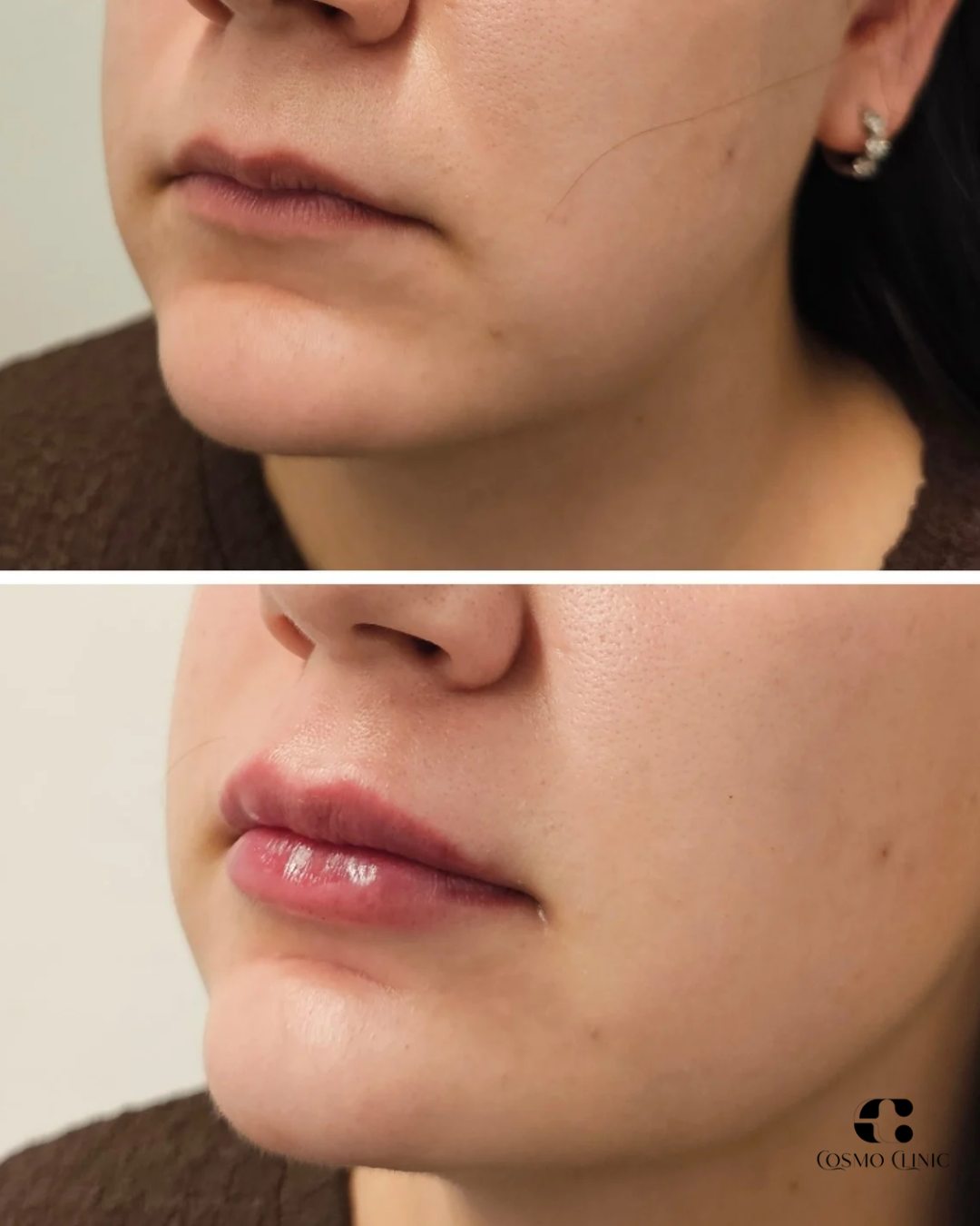 Close-up comparison of lips and lower face before and after cosmetic treatment, showing smoother skin and fuller lips in the after image, with a logo in the bottom right corner.