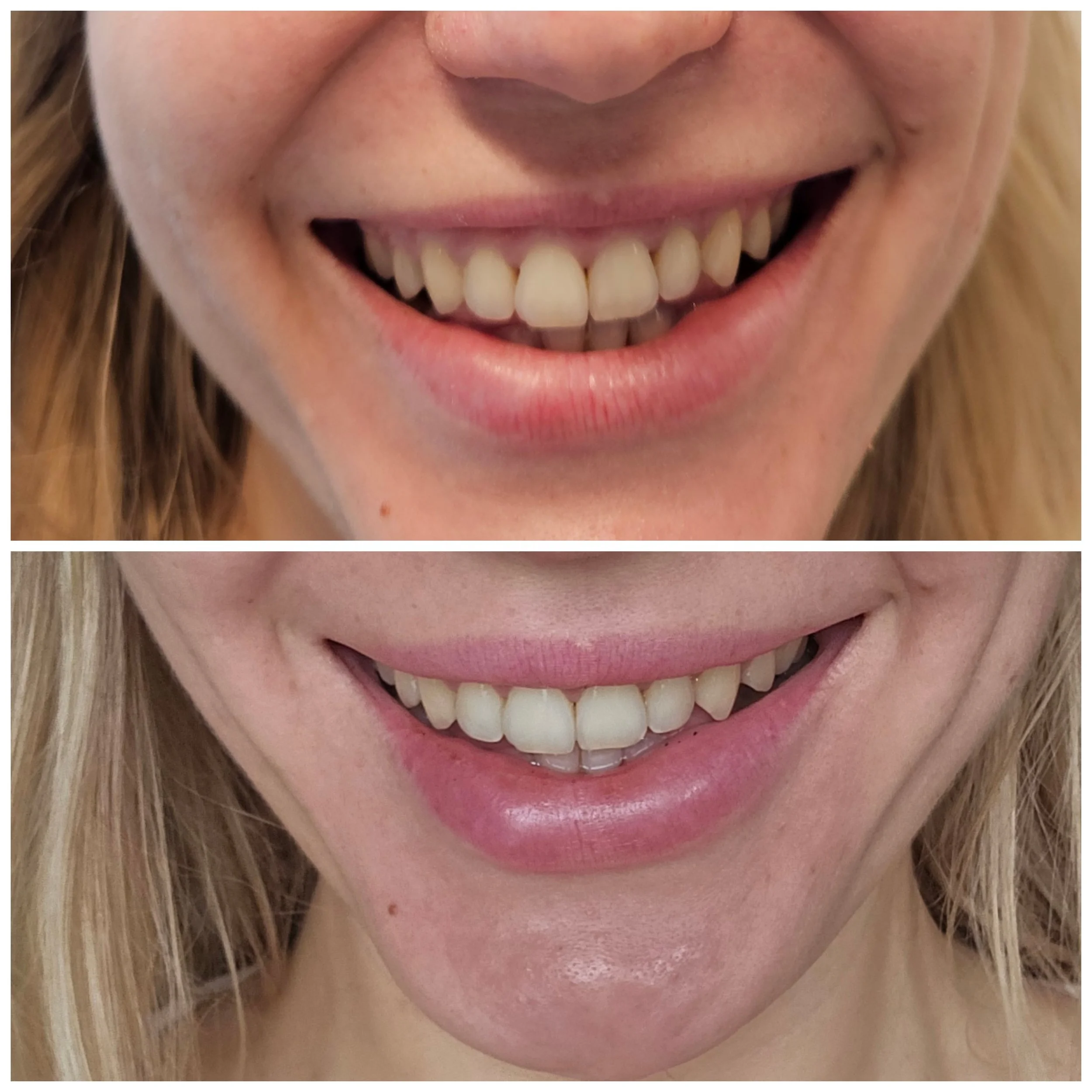 Comparison of a person's smile before and after dental treatment, showing improved teeth alignment and appearance in the bottom image.