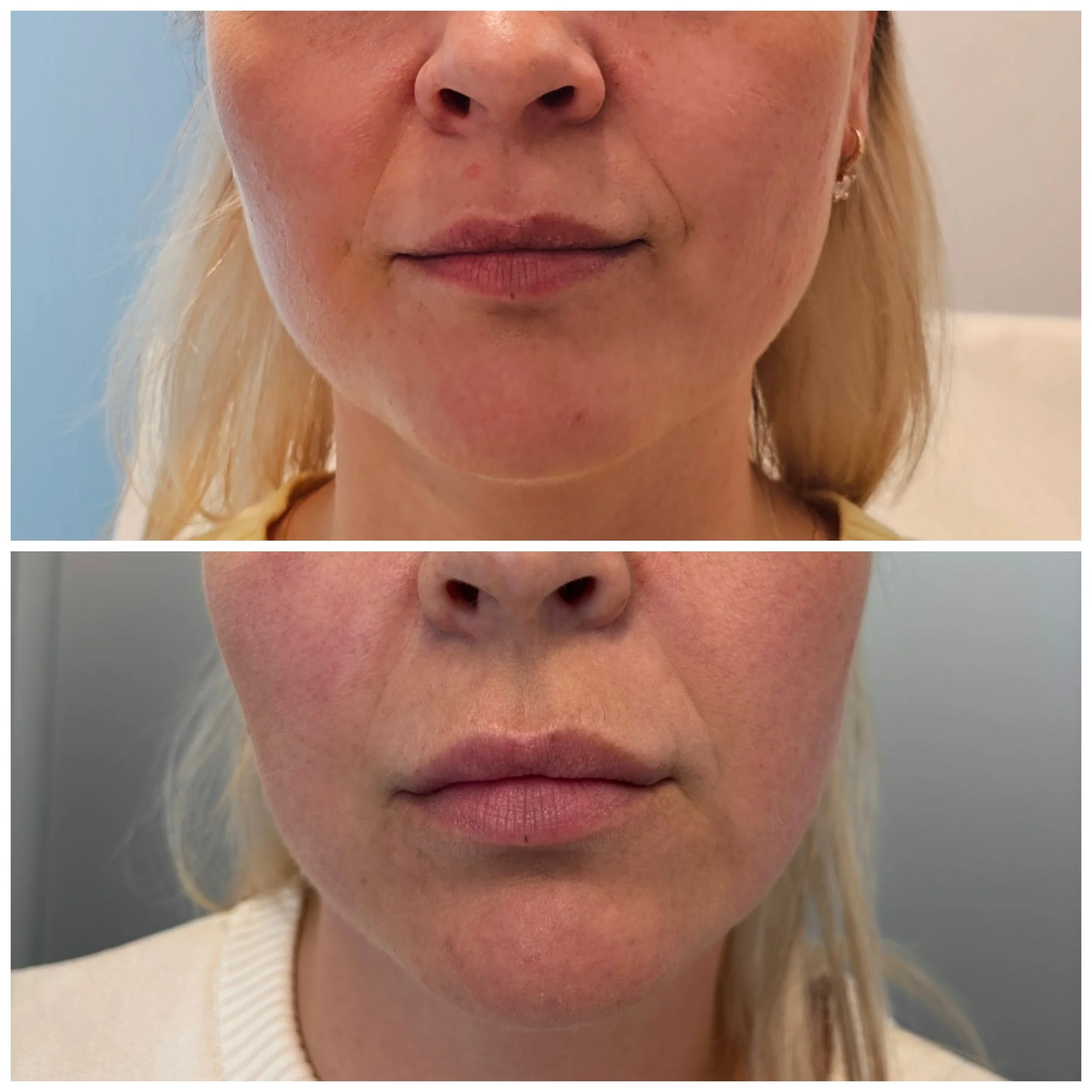 Close-up comparison of a woman's lower face before and after cosmetic treatment, showing changes in skin texture and lip appearance.