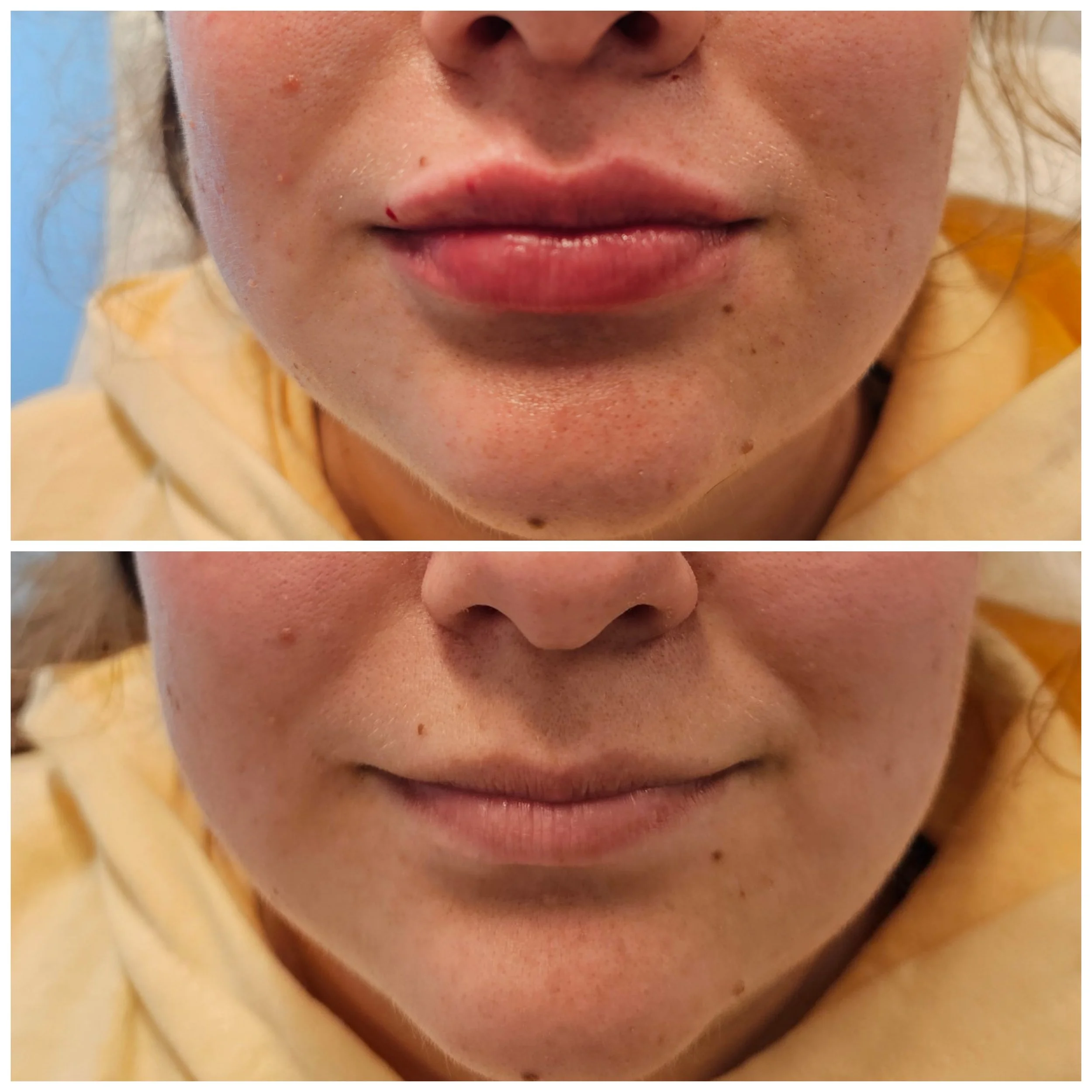 Close-up of a person's mouth showing before and after images; the upper image shows lip fillers with minor bleeding and swelling, the lower image shows smooth, natural lips after treatment.