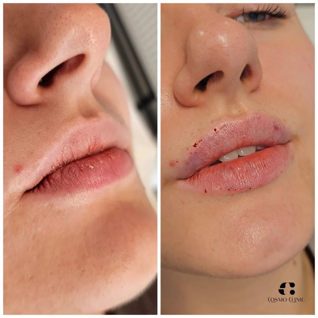 Close-up of a woman's lips before and after cosmetic treatment, showing improved lip appearance and minor bleeding after the procedure.