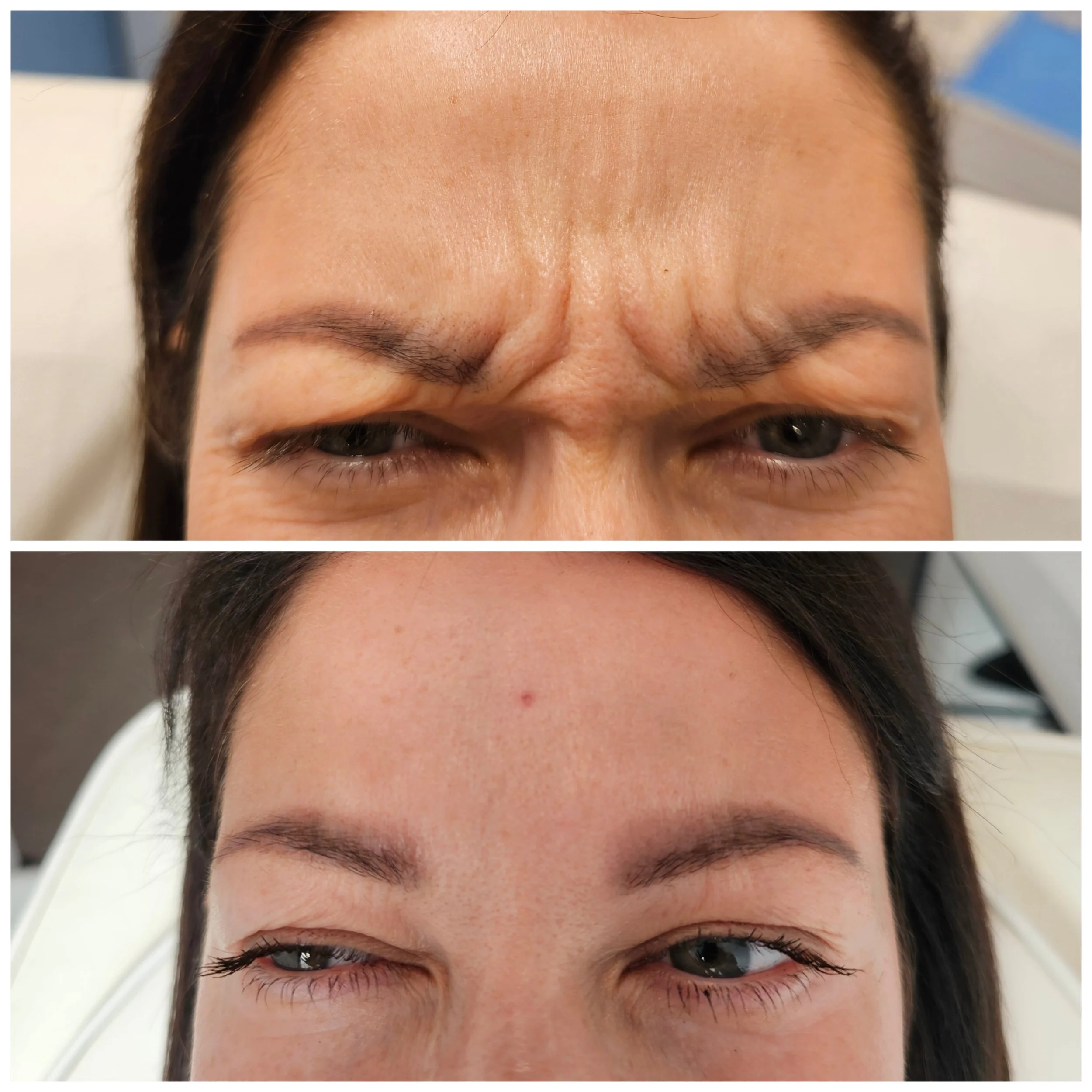 Before and after images of a woman showing forehead and eye improvements; the top image shows furrowed brows and wrinkles, while the bottom image shows smoother skin and reduced wrinkles.
