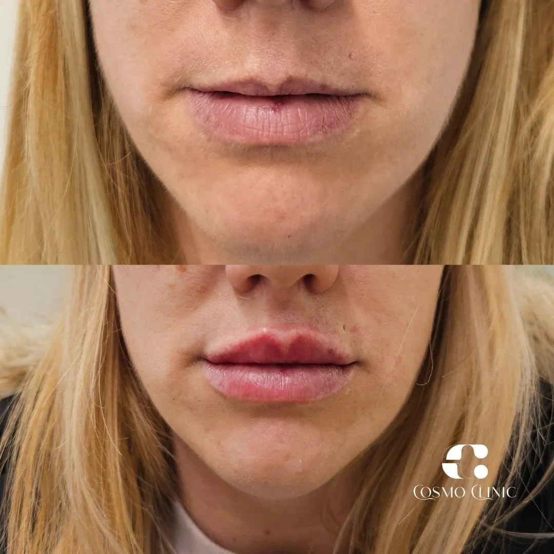 Close-up of a woman's lips before and after cosmetic lip treatment, with the 'Cosmo Clinic' logo in the bottom right corner.