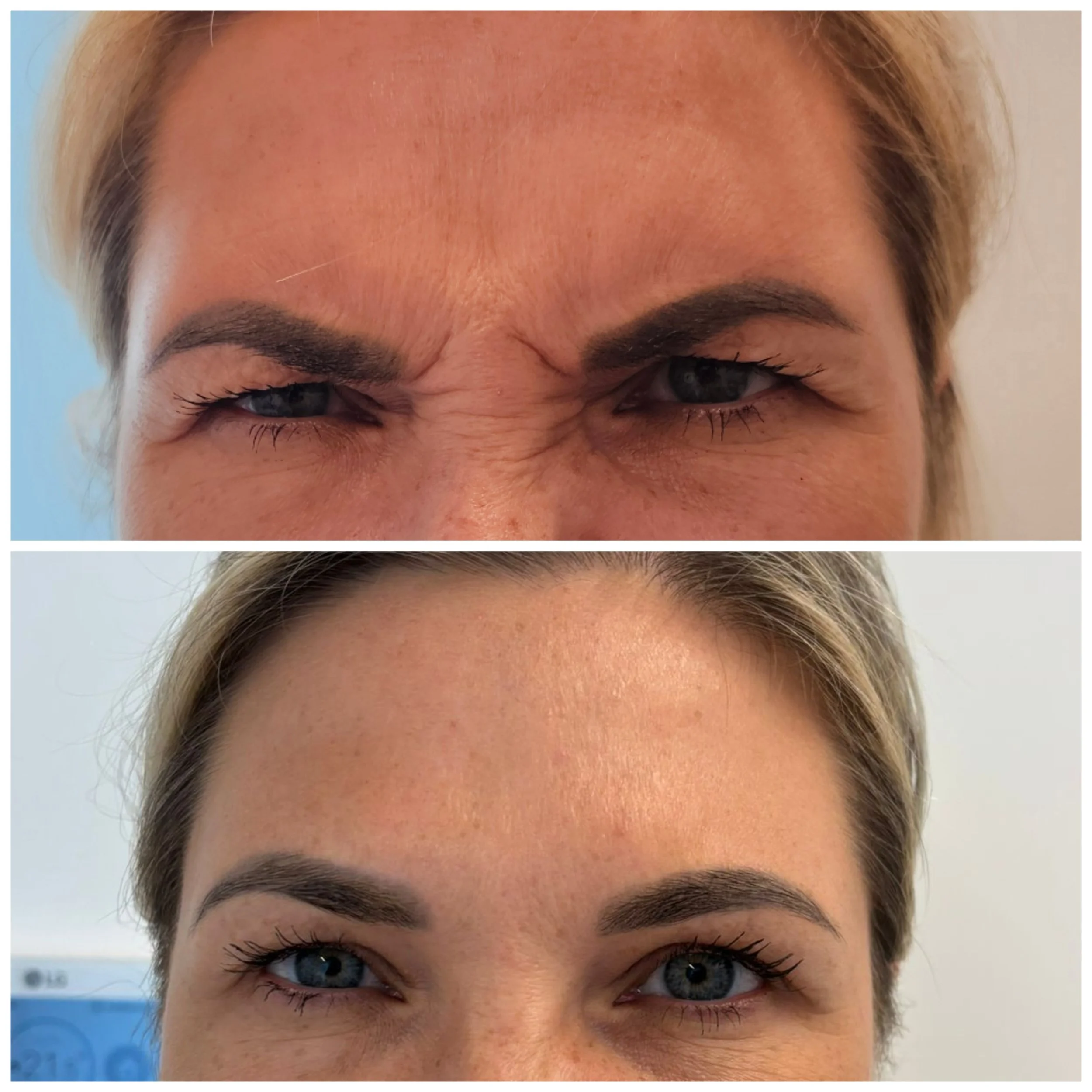 Side-by-side comparison of a woman's face showing angry or scrunched expressions in the top image and a relaxed or neutral expression in the bottom image.