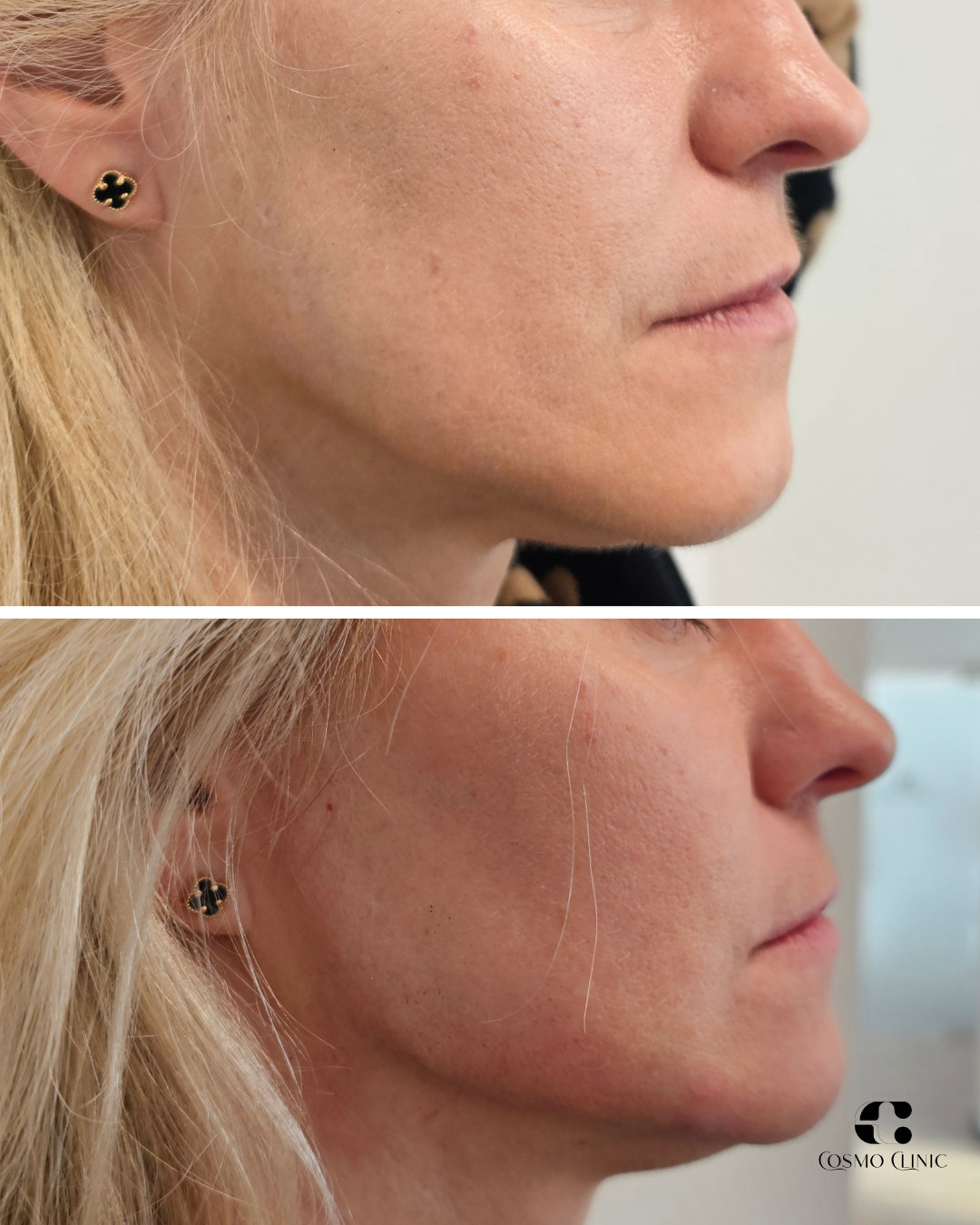 Close-up side views of a woman's face before and after cosmetic skin treatment, showing improved skin texture and reduced blemishes. The woman wears a black and gold earring and has long blonde hair.