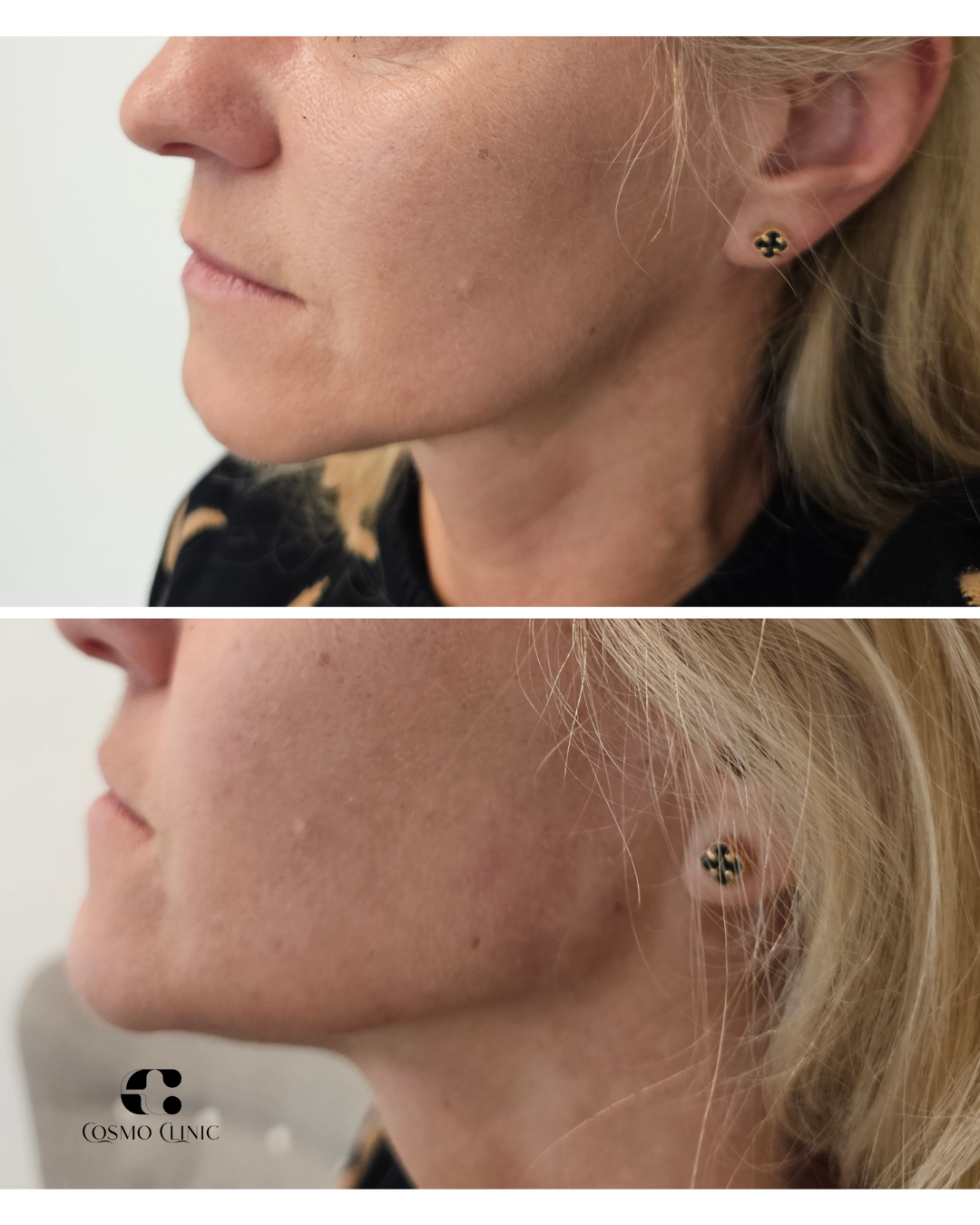 Close-up of a woman's side face before and after a cosmetic treatment, showing improved skin texture and smoothness.