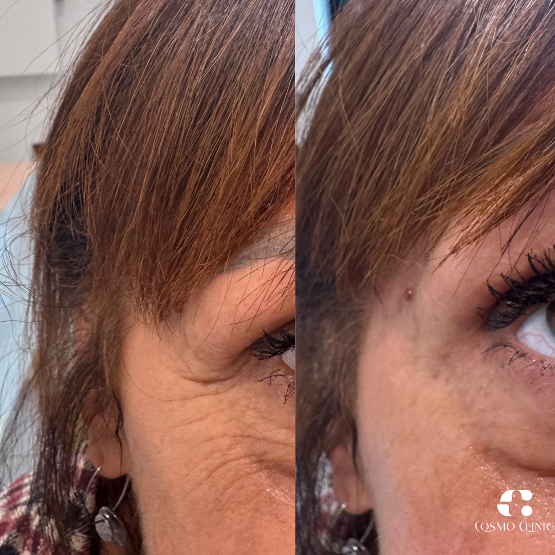 Close-up view of a woman's face showing a before-and-after comparison of facial skin with improved smoothness and reduced wrinkles after cosmetic treatment.