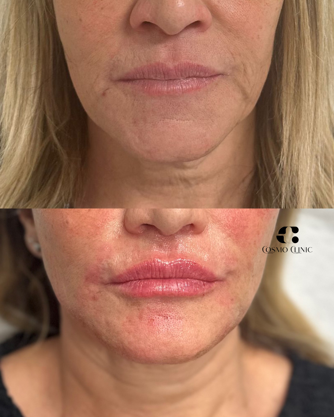 Close-up of a woman's lips before and after cosmetic lip enhancement, showing smoother, fuller lips after treatment.