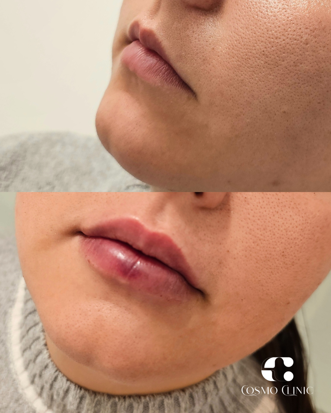 Close-up of a person's lips and lower face before and after lip enhancement, with the Cosmo Clinic logo.