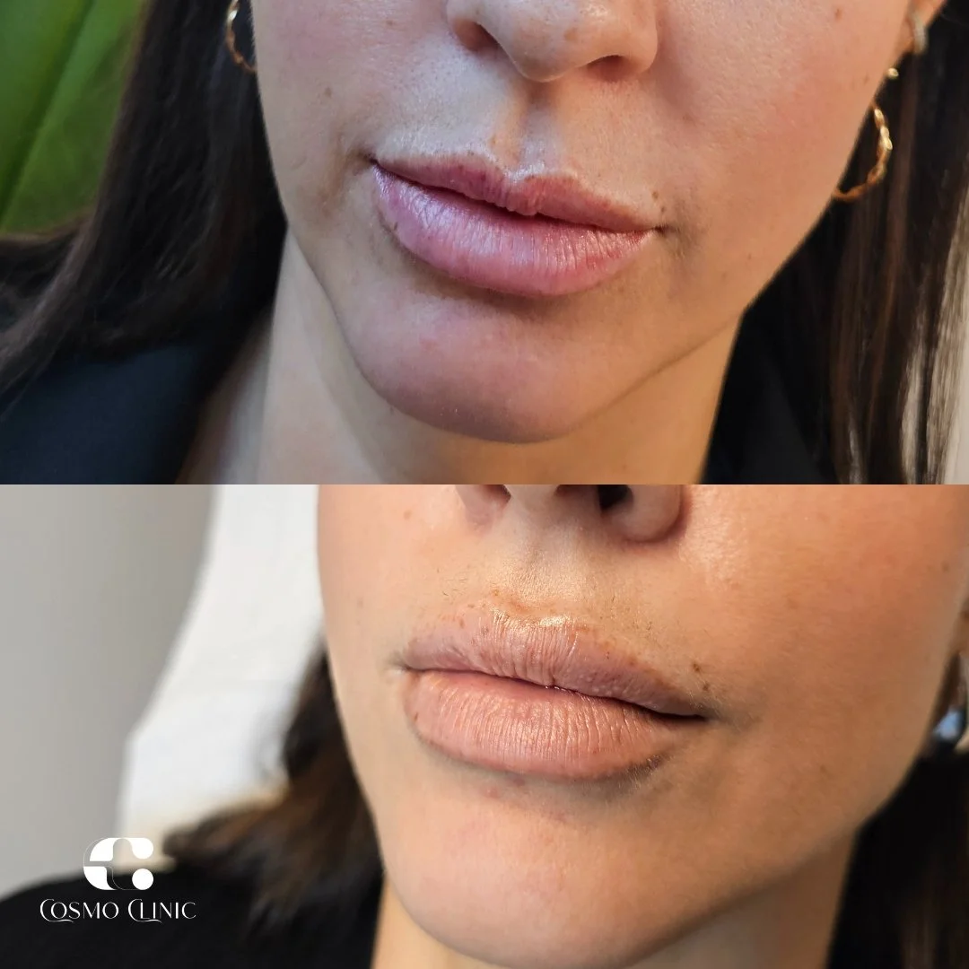 Close-up of a woman's lips before and after a cosmetic lip treatment, showing improved lip volume and shape in the after image.