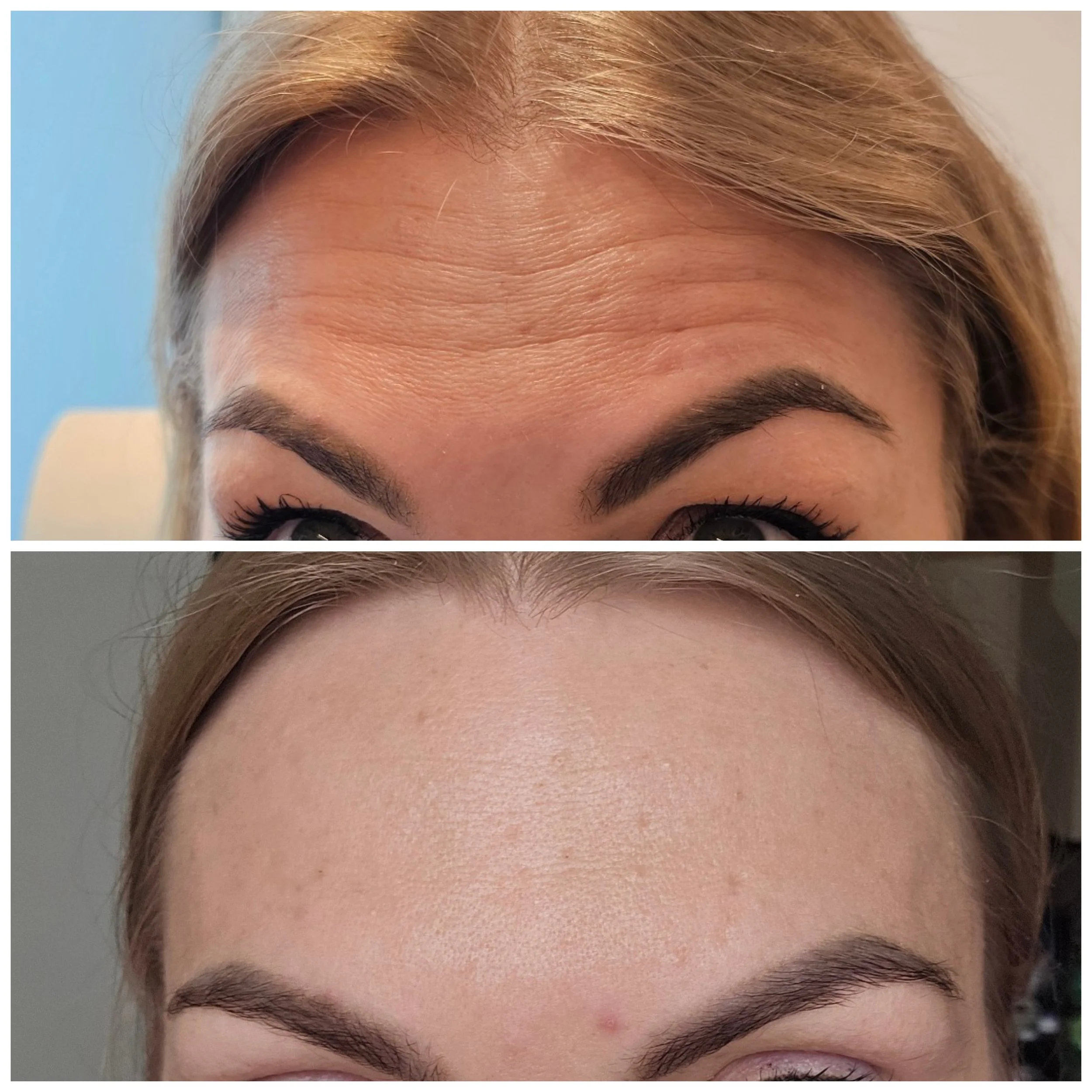 Before and after close-up of a woman's forehead and eyebrows, showing reduced wrinkles and smoother skin in the after photo.