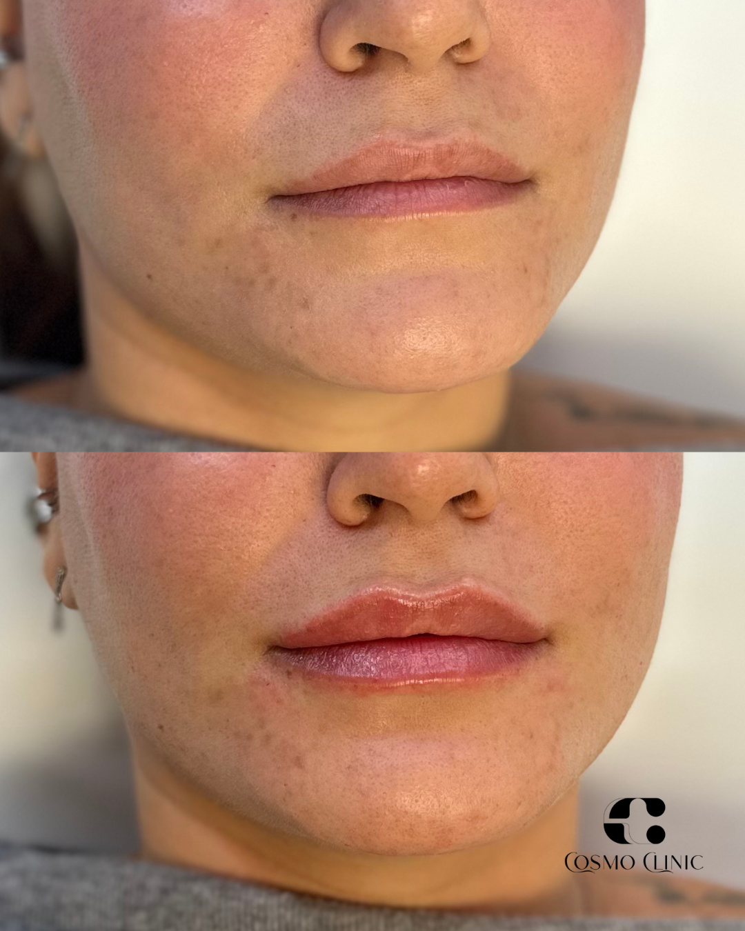 Close-up photo of a woman's lips and lower face, showing before and after lip enhancement. The bottom image displays fuller, glossier lips with a slight smile, with the logo 'Cosmo Clinic' in the lower right corner.