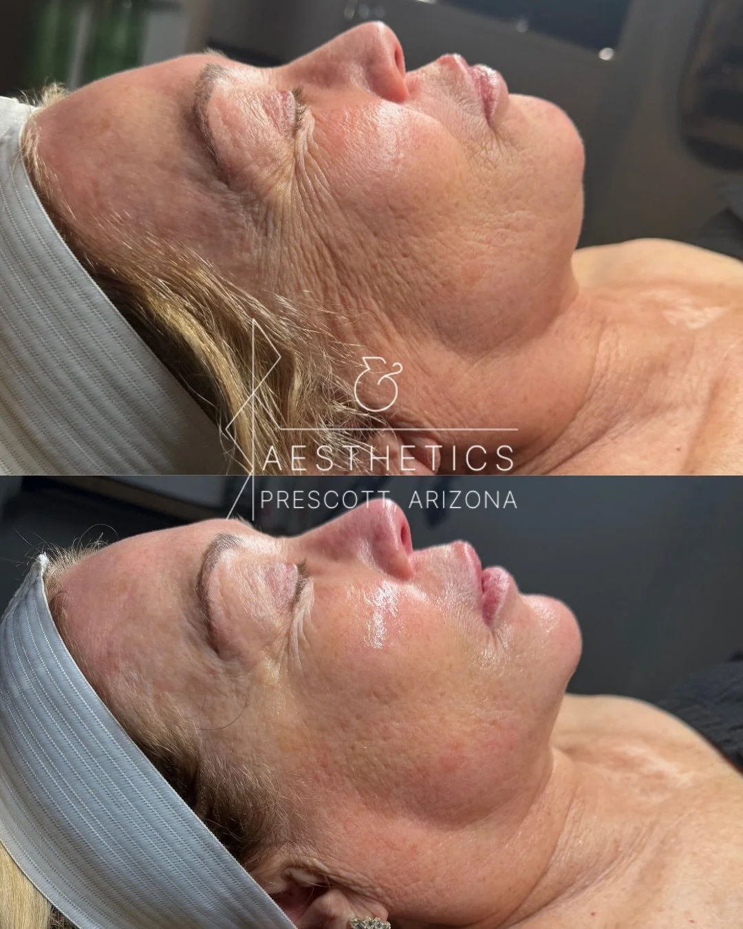 These results speak for themselves. Two sessions, one month apart, the bottom picture is immediately after the 2nd treatment. WOW. It&rsquo;s PRP without the blood.

What you want to know: @microchanneling is an advanced skin rejuvenation treatment p