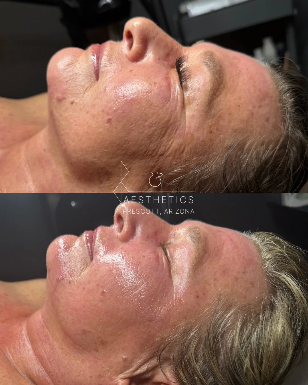 @microchanneling transformation. This one&rsquo;s very special to me because the process didn&rsquo;t have expectations initially, it was total trust right from the start and total dedication from this beautiful human. She didn&rsquo;t know what she 