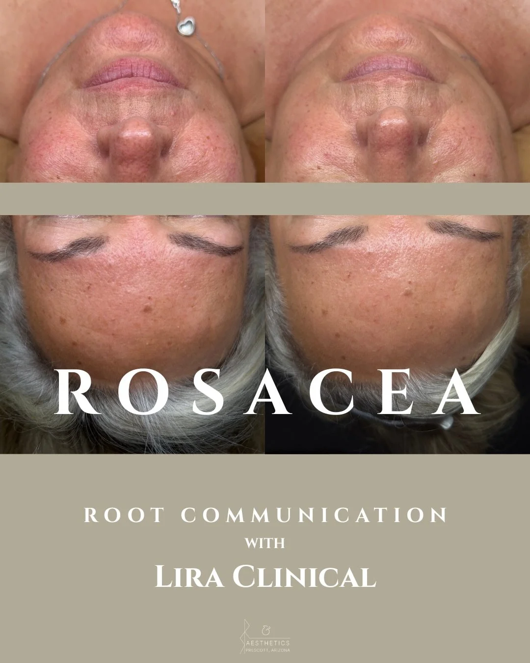 Three-step Lira Clinical routine.
Elimination of prescribed tretinoin.
Four weeks of consistency.

That&rsquo;s it.

This is the kind of transformation that can happen through root communication skincare, intentional barrier support, and of course, @