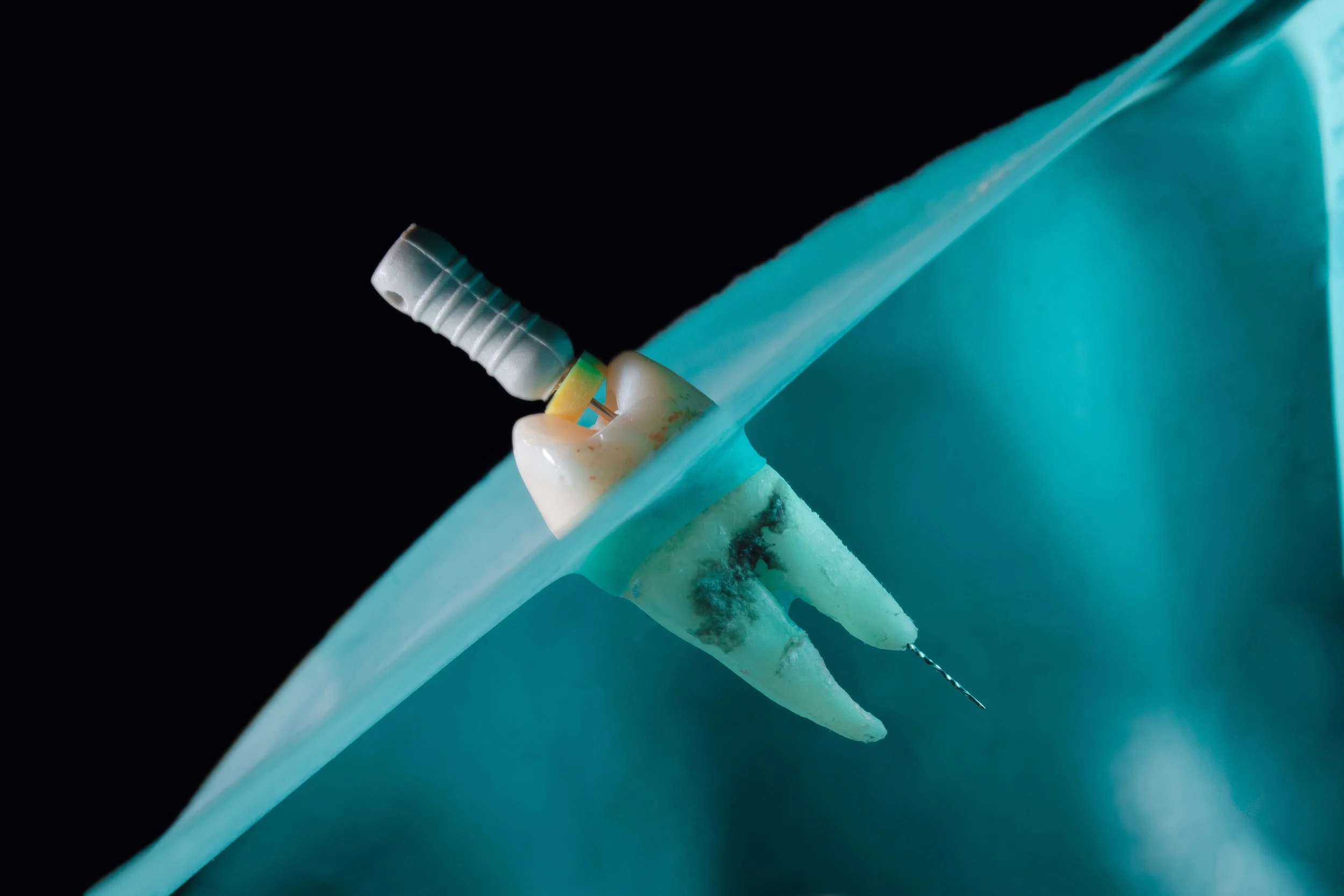 Root Canal Retreatment