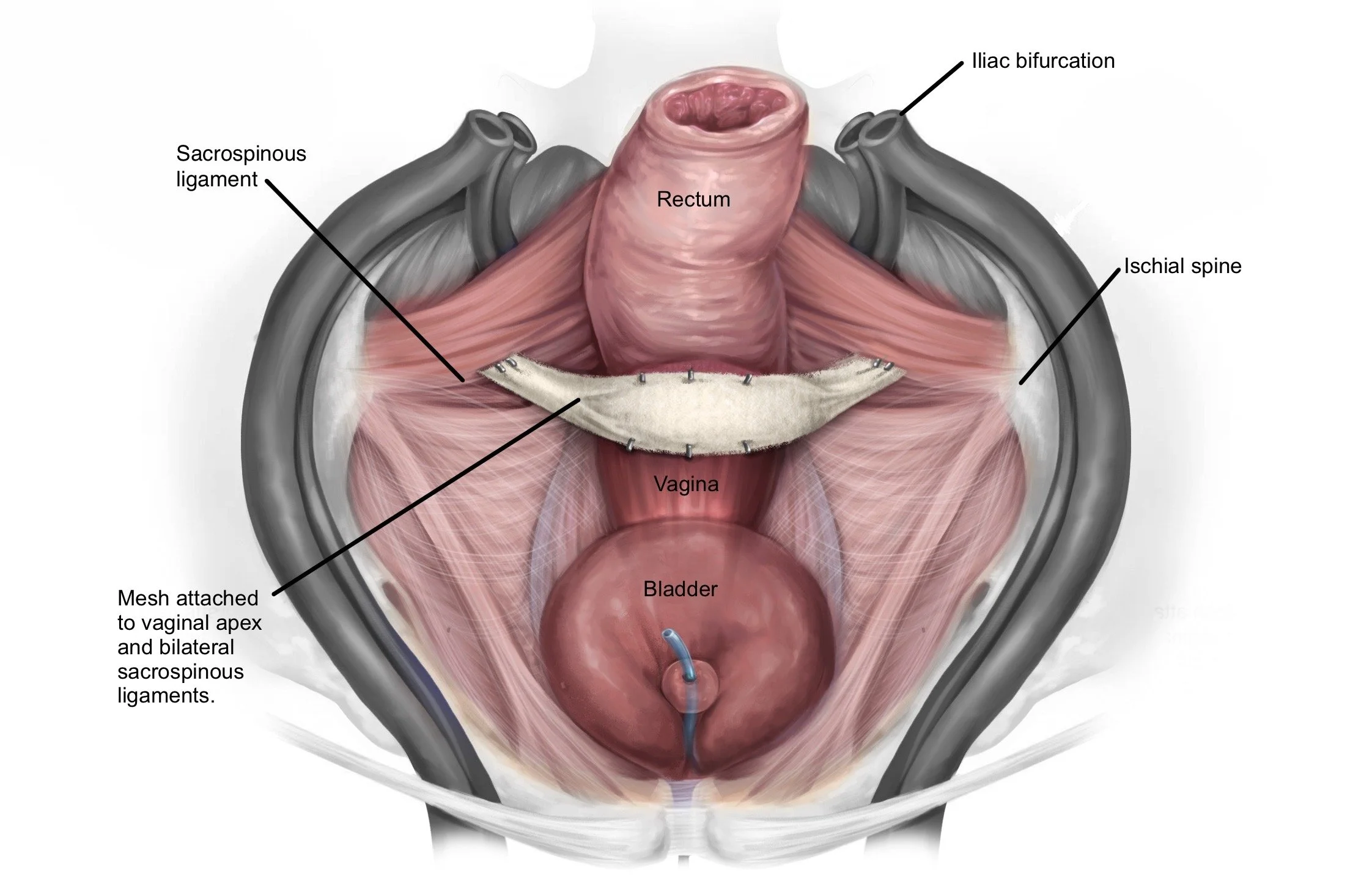 Anatomical illustration of female pelvic organs showing the rectum, vagina with mesh implant, bladder, iliac bifurcation, sacrospinous ligament, and ischial spine.