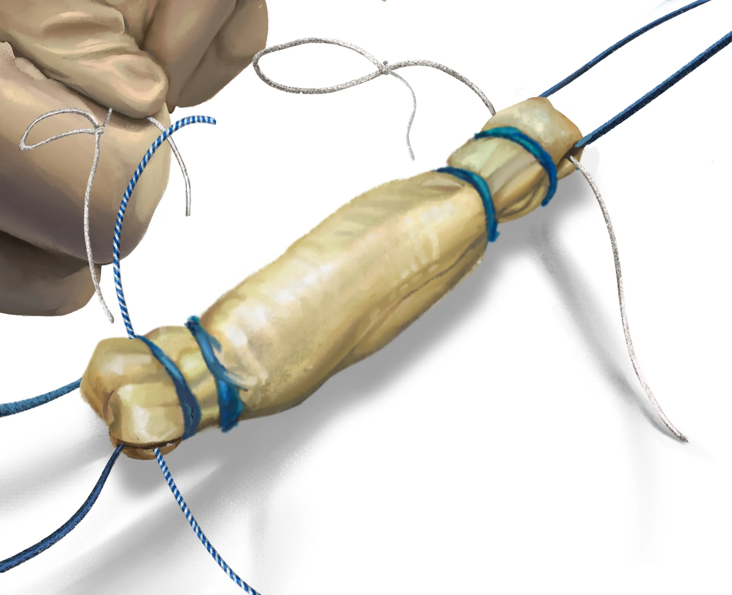 A surgical procedure involving a tendon graft. A hand in a latex glove holds a section of tendon, which is sewn and stitched with blue and white sutures.